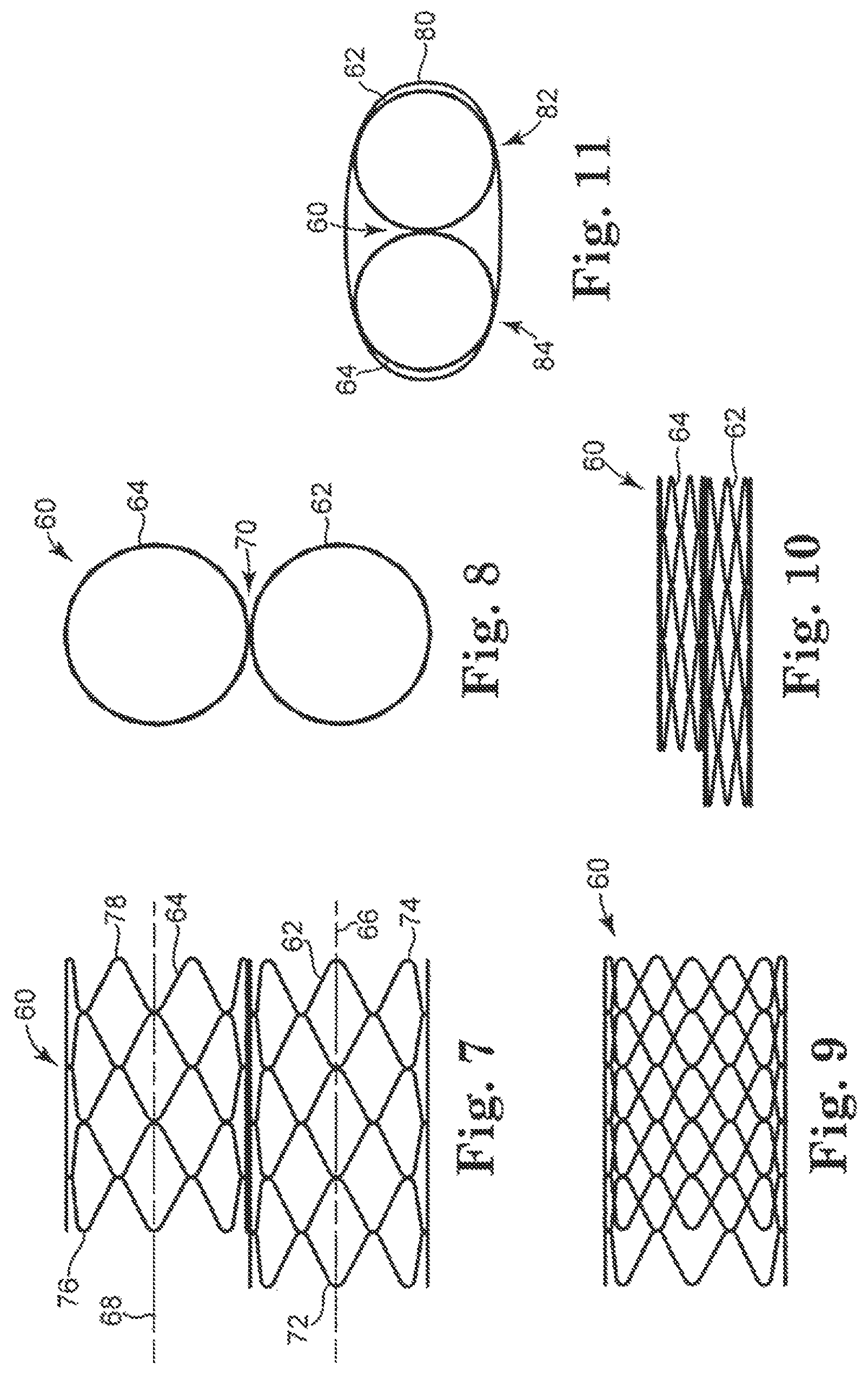 Patent US12350148 Figure 2 – Stented heart valve devices and methods for atrioventricular valve replacement