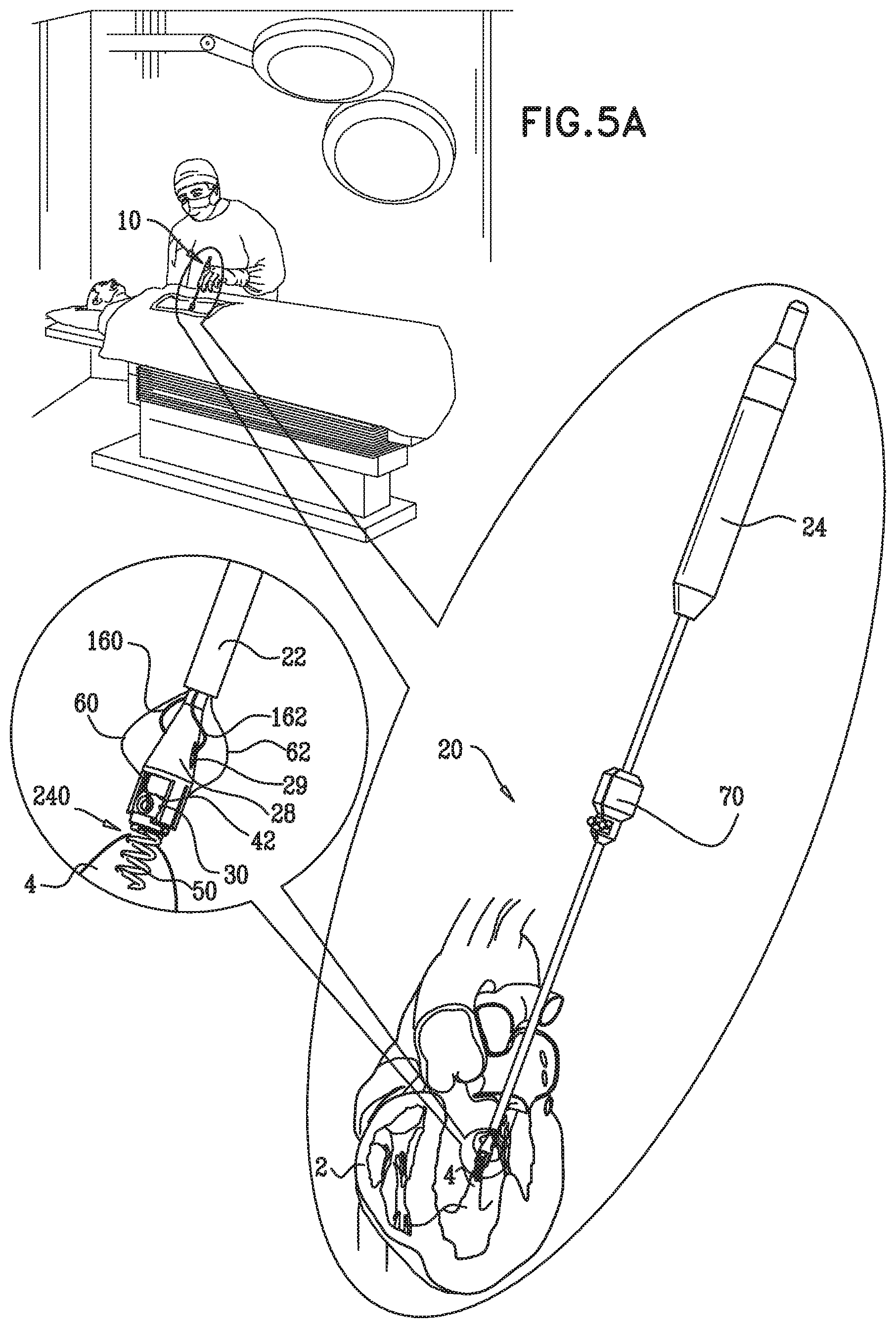 Patent US12350149 Figure 6 – Method and apparatus for repairing a heart valve
