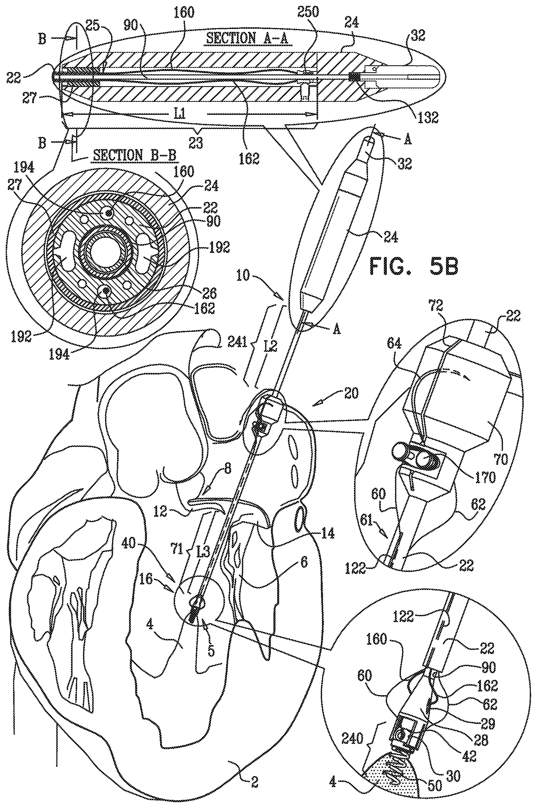 Patent US12350149 Figure 7 – Method and apparatus for repairing a heart valve