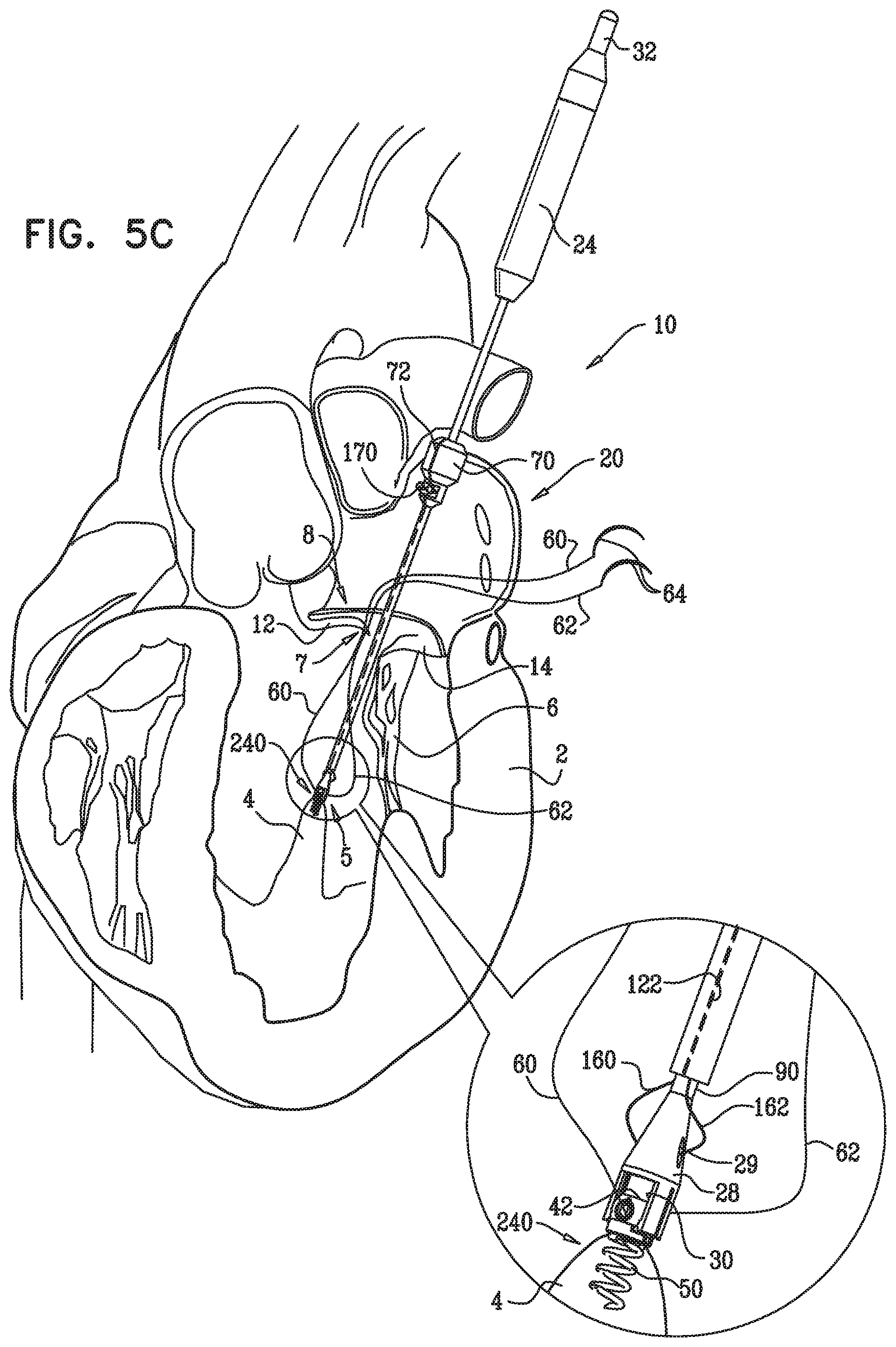 Patent US12350149 Figure 8 – Method and apparatus for repairing a heart valve