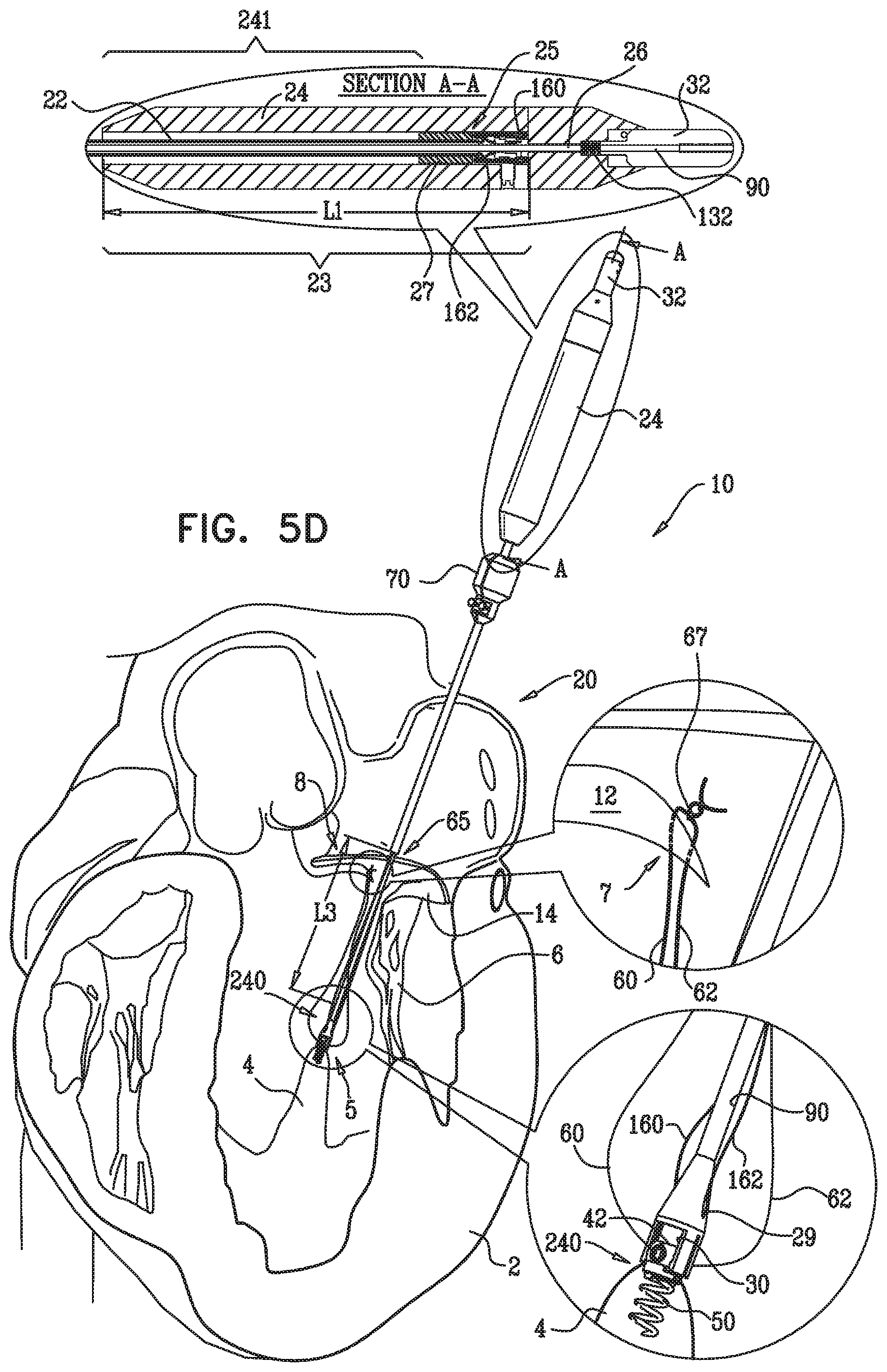 Patent US12350149 Figure 9 – Method and apparatus for repairing a heart valve
