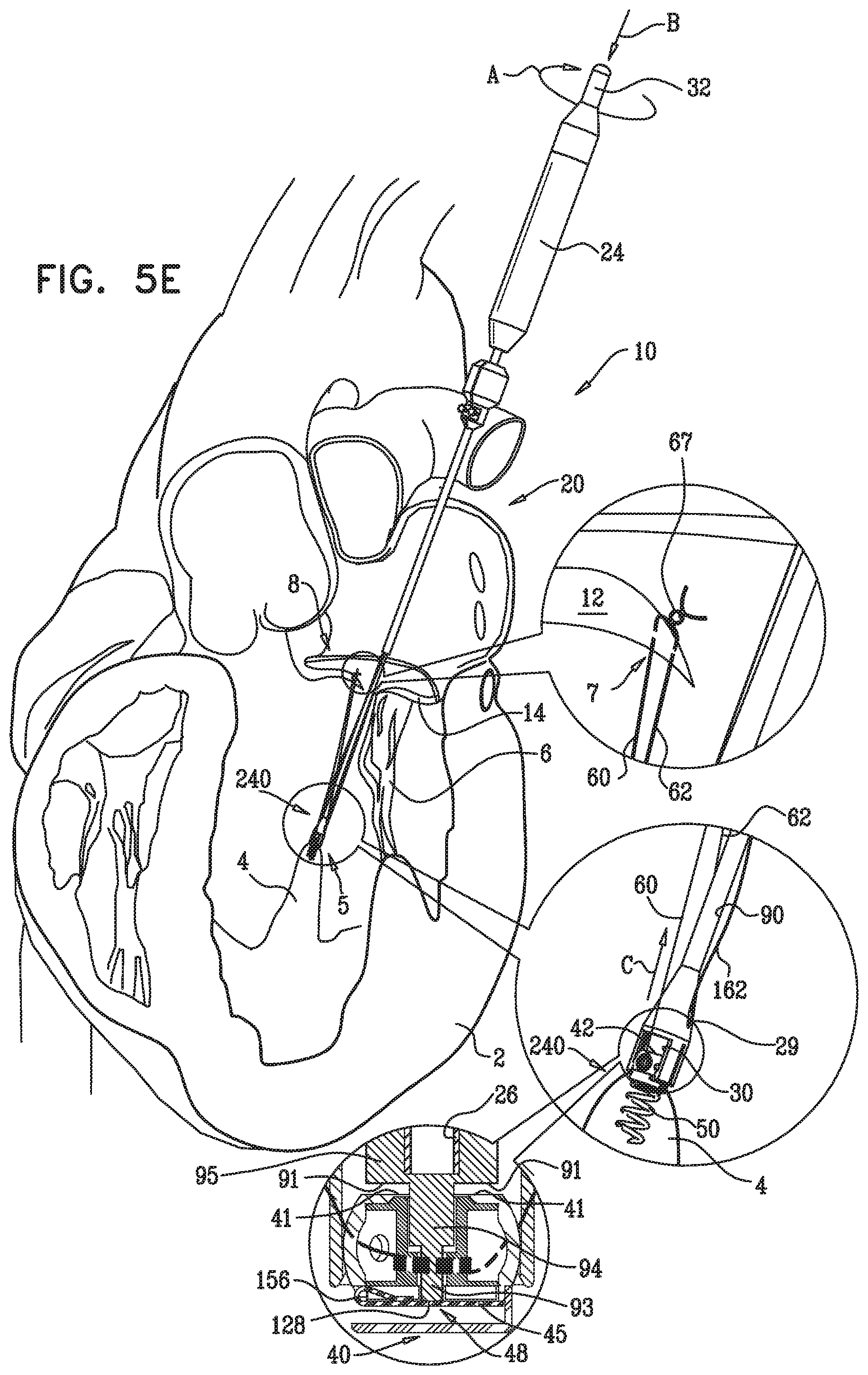 Patent US12350149 Figure 10 – Method and apparatus for repairing a heart valve