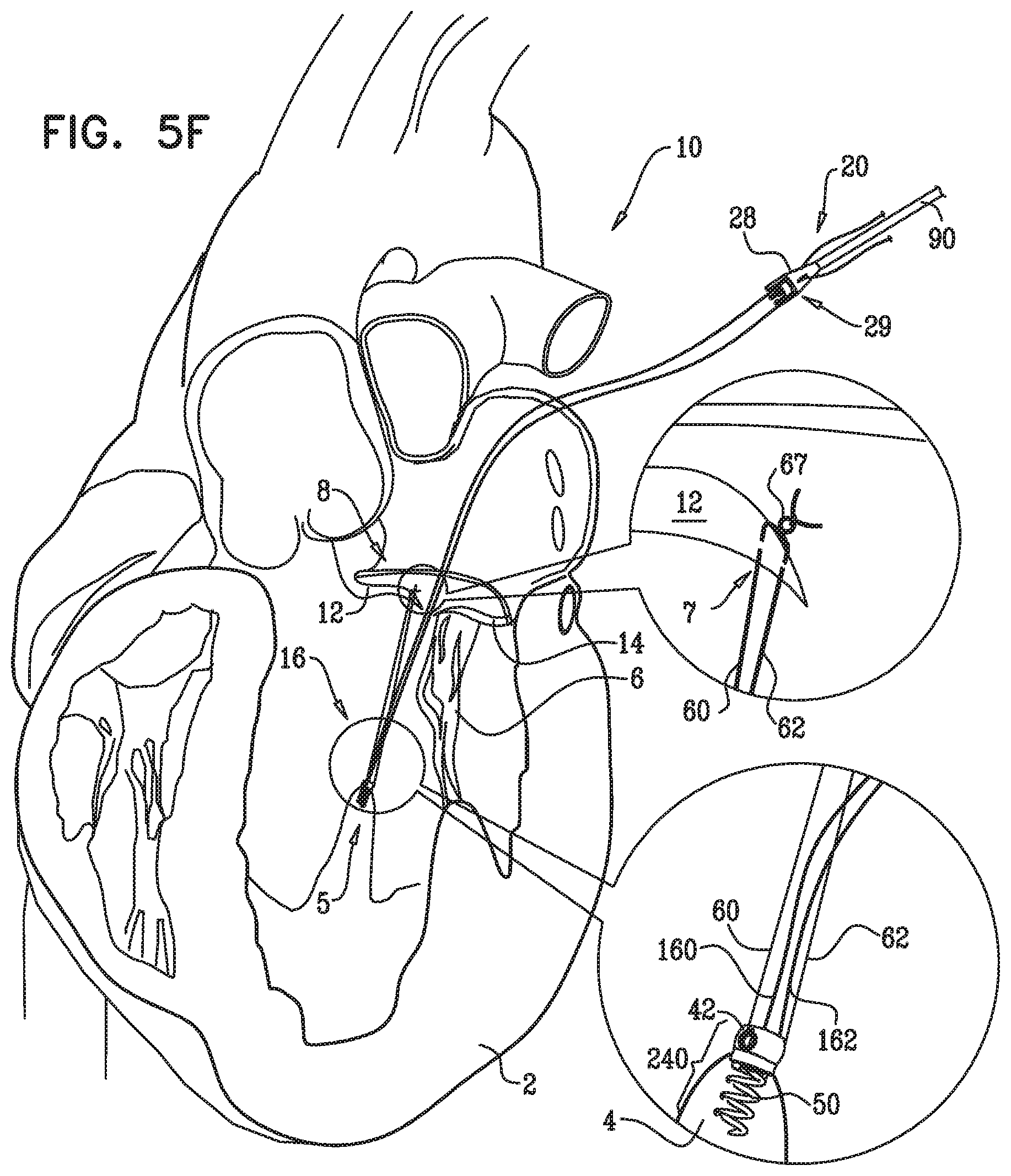 Patent US12350149 Figure 11 – Method and apparatus for repairing a heart valve