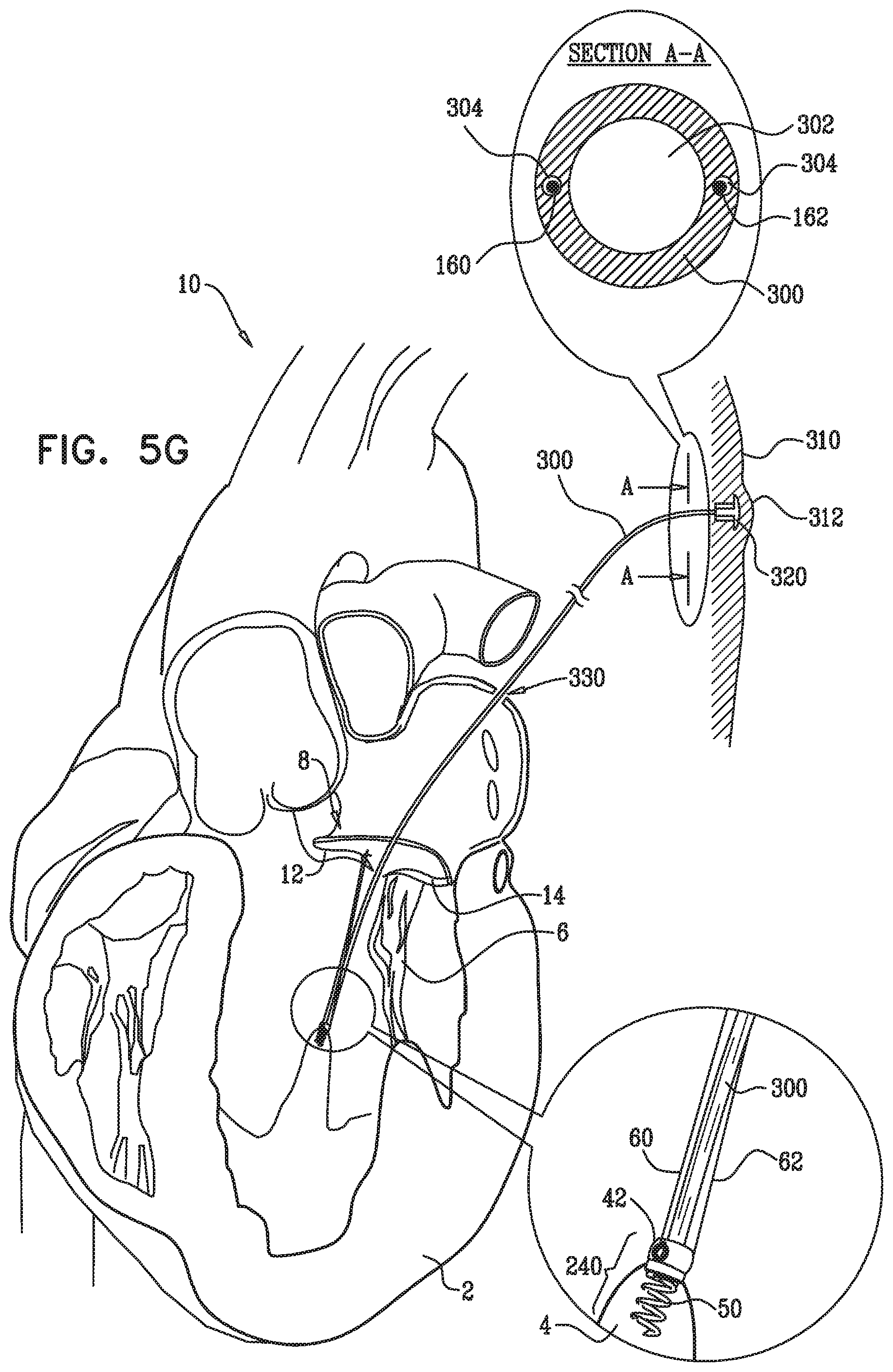 Patent US12350149 Figure 12 – Method and apparatus for repairing a heart valve
