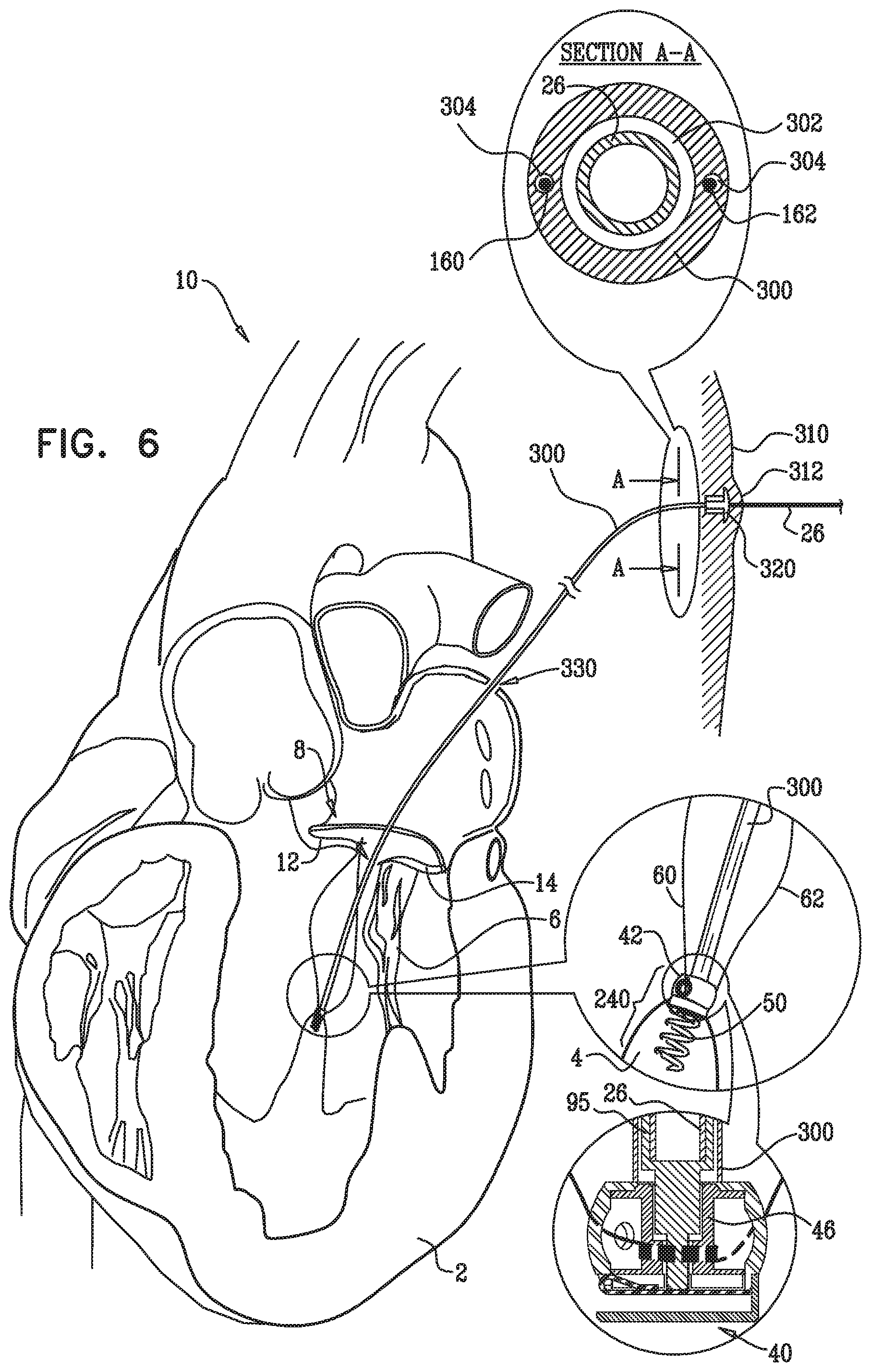 Patent US12350149 Figure 13 – Method and apparatus for repairing a heart valve