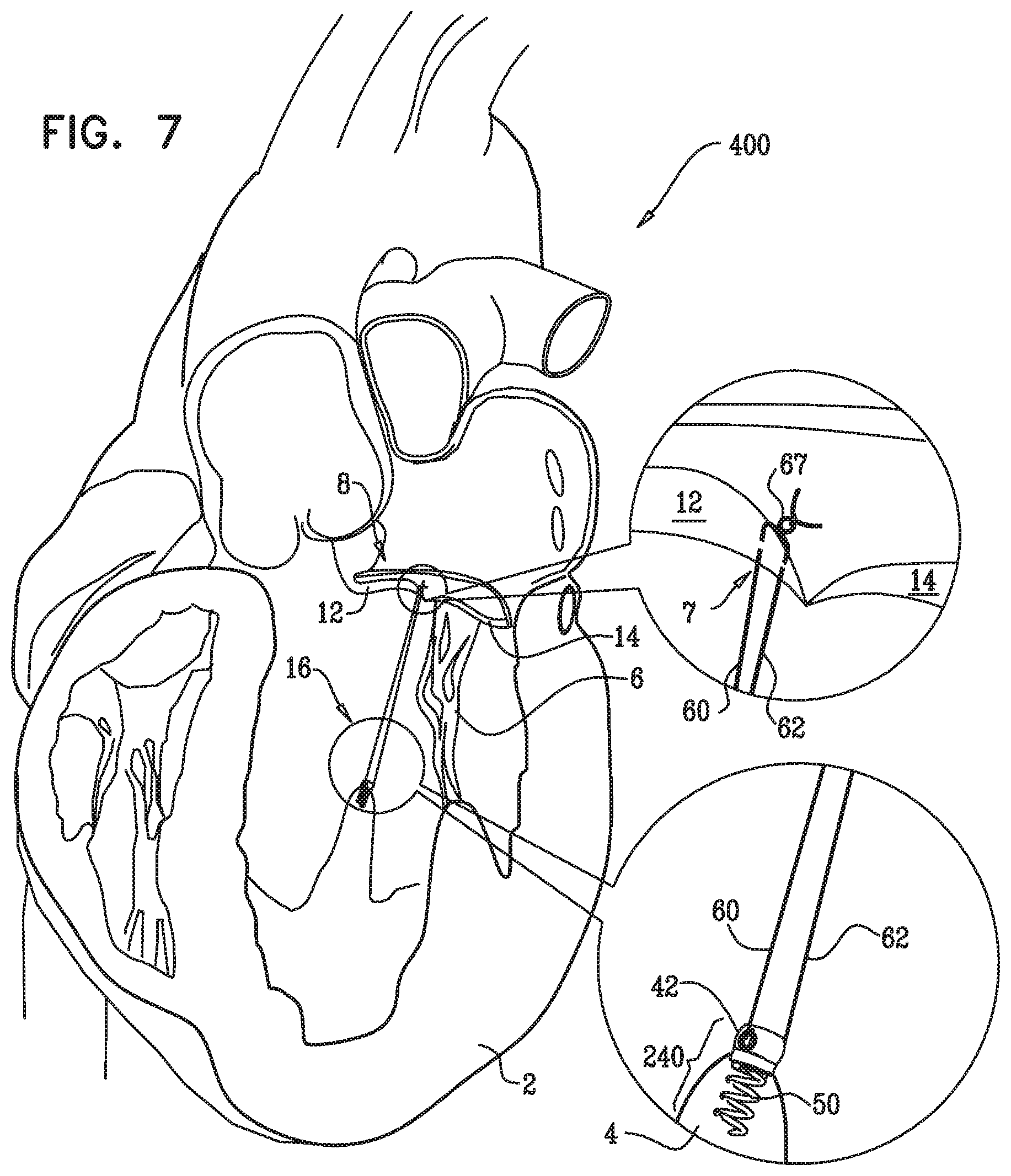 Patent US12350149 Figure 14 – Method and apparatus for repairing a heart valve