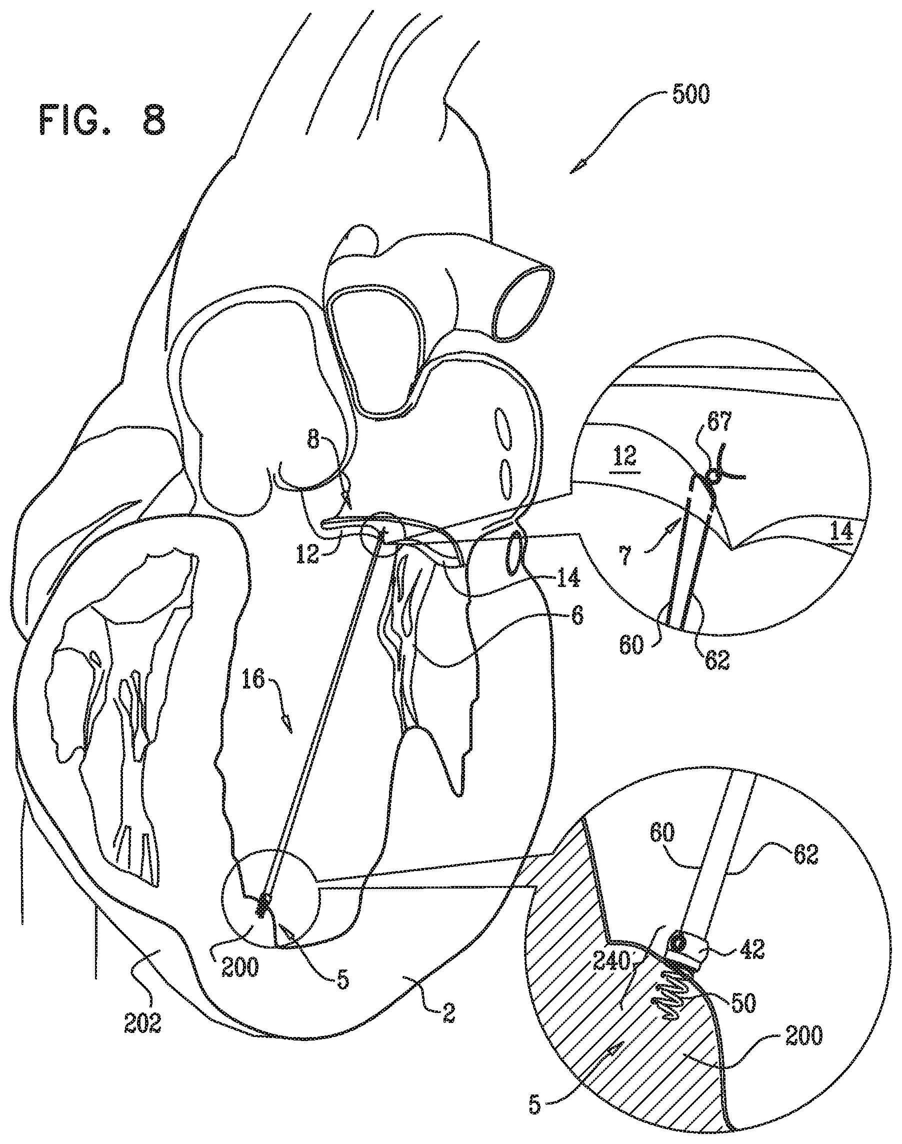 Patent US12350149 Figure 15 – Method and apparatus for repairing a heart valve