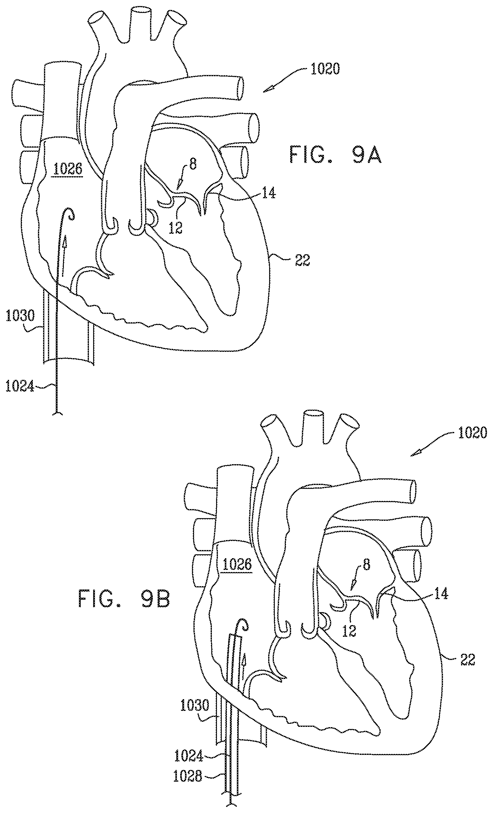 Patent US12350149 Figure 16 – Method and apparatus for repairing a heart valve