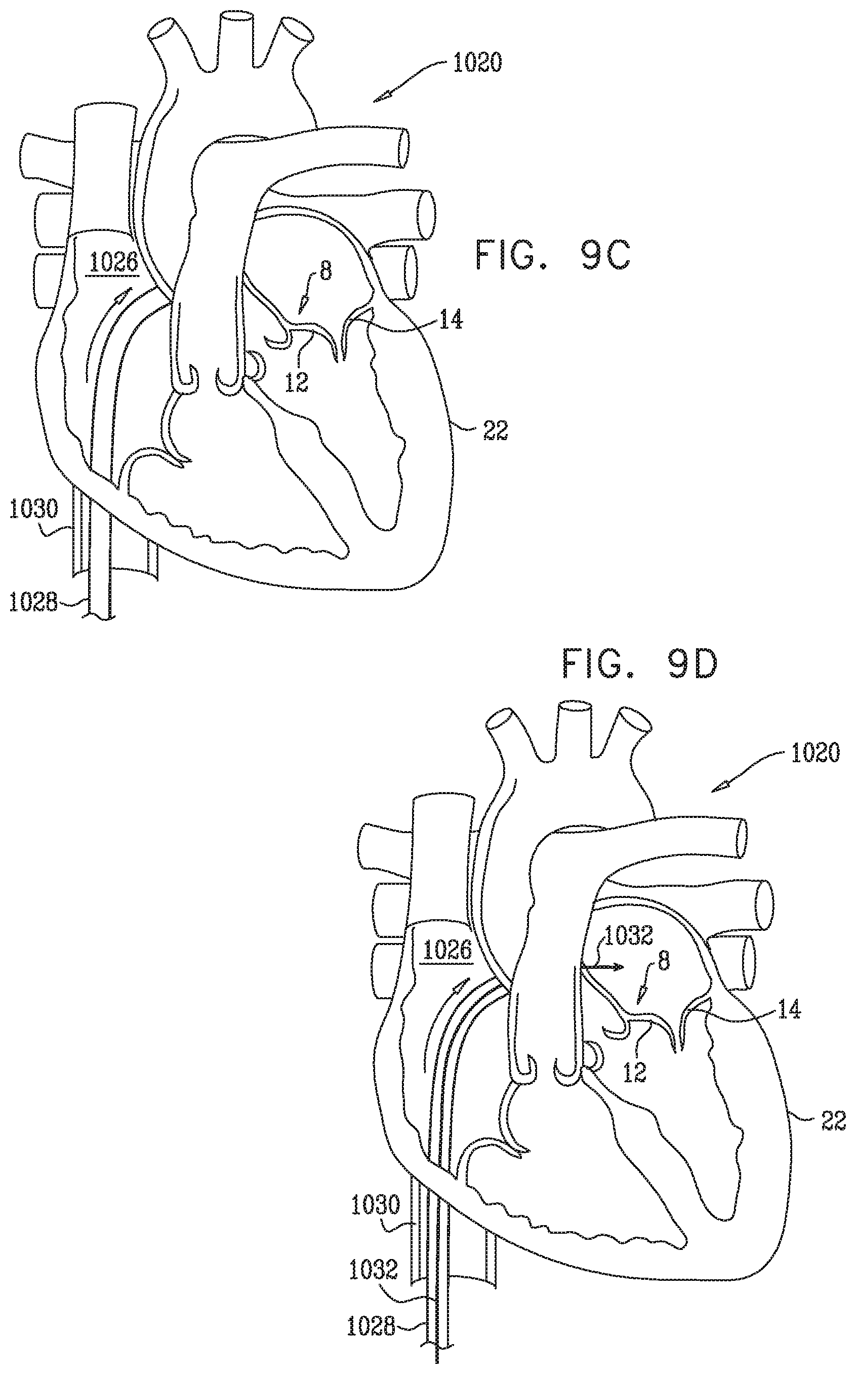 Patent US12350149 Figure 17 – Method and apparatus for repairing a heart valve