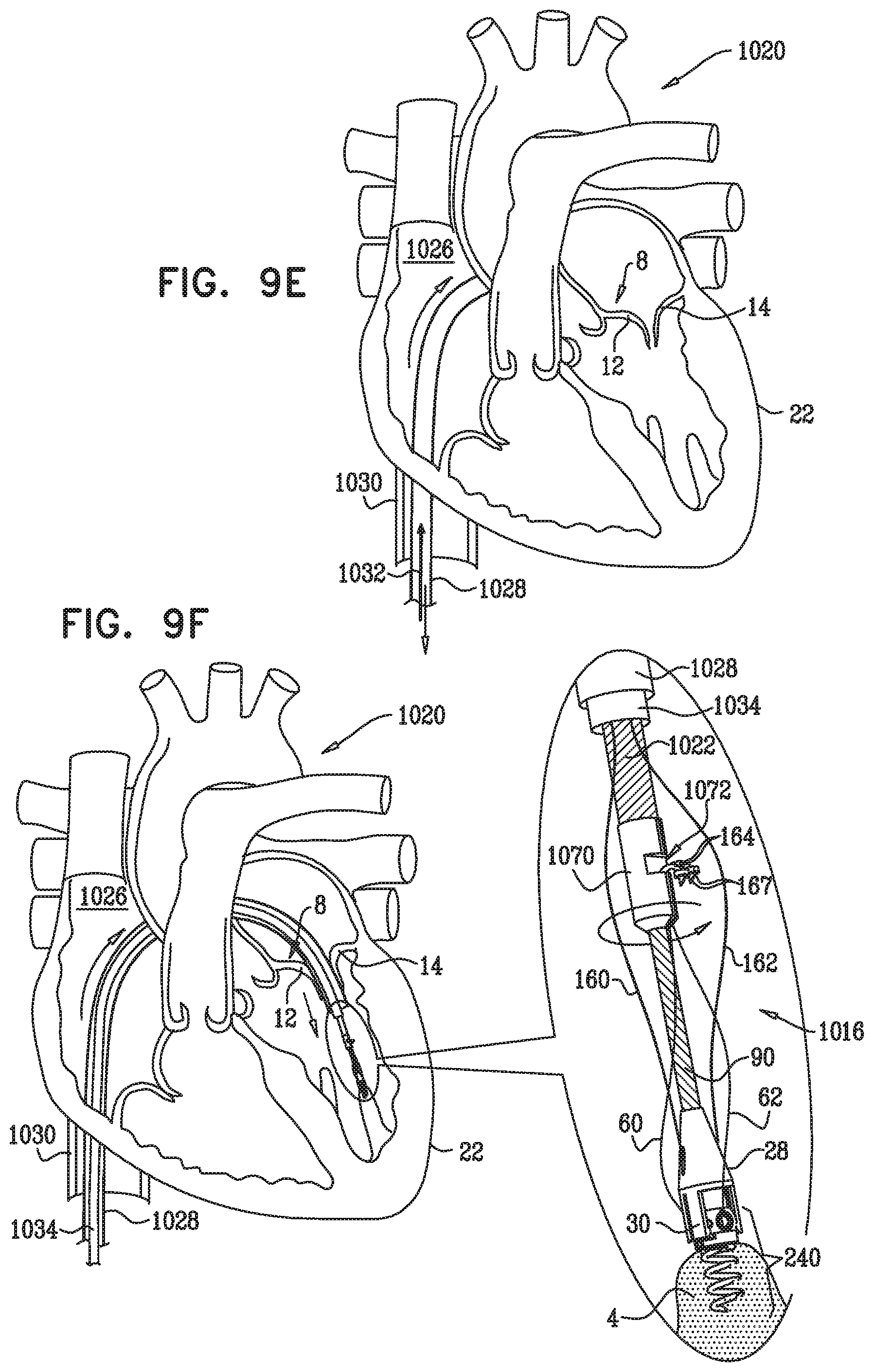 Patent US12350149 Figure 18 – Method and apparatus for repairing a heart valve