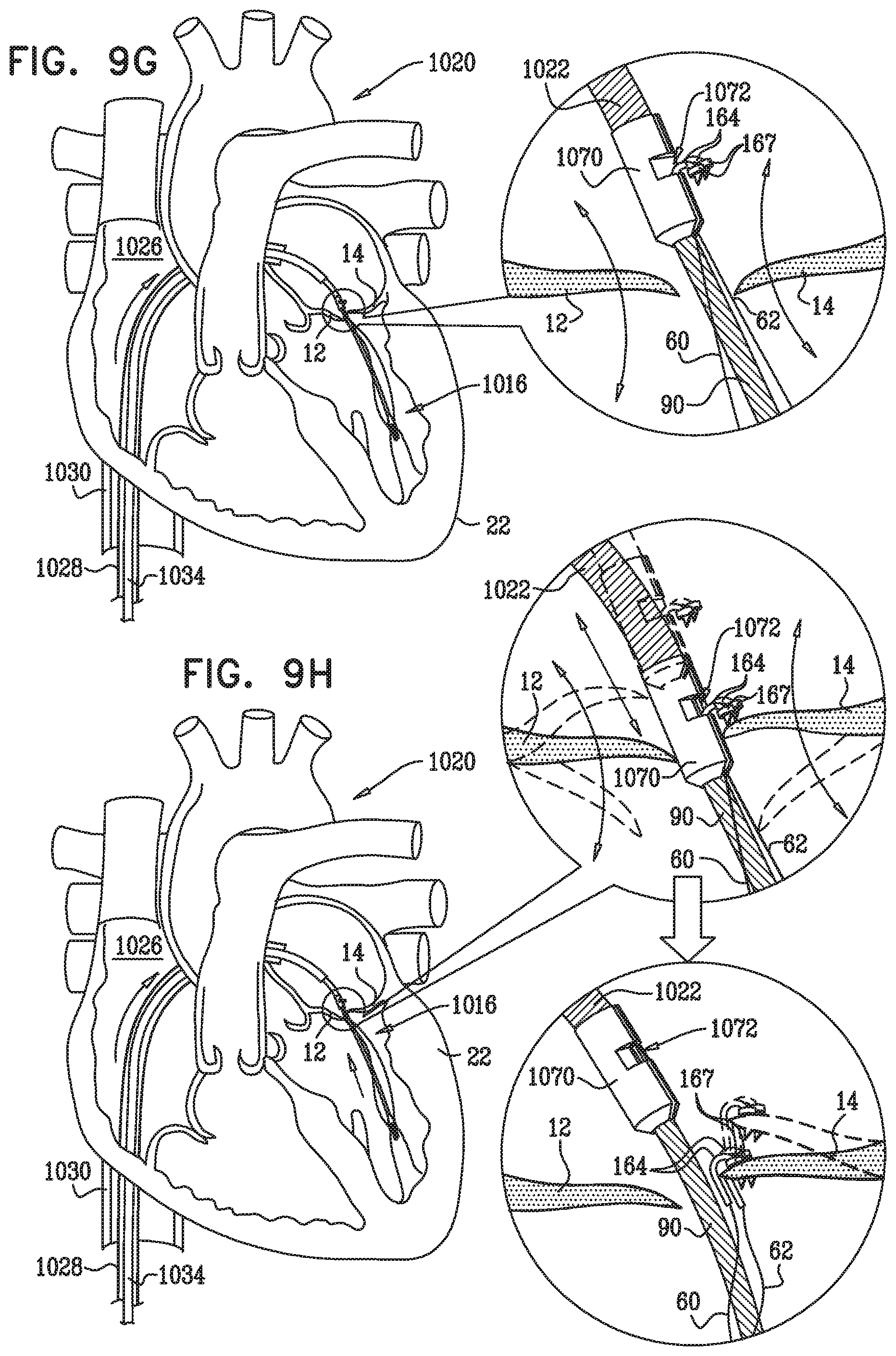 Patent US12350149 Figure 19 – Method and apparatus for repairing a heart valve