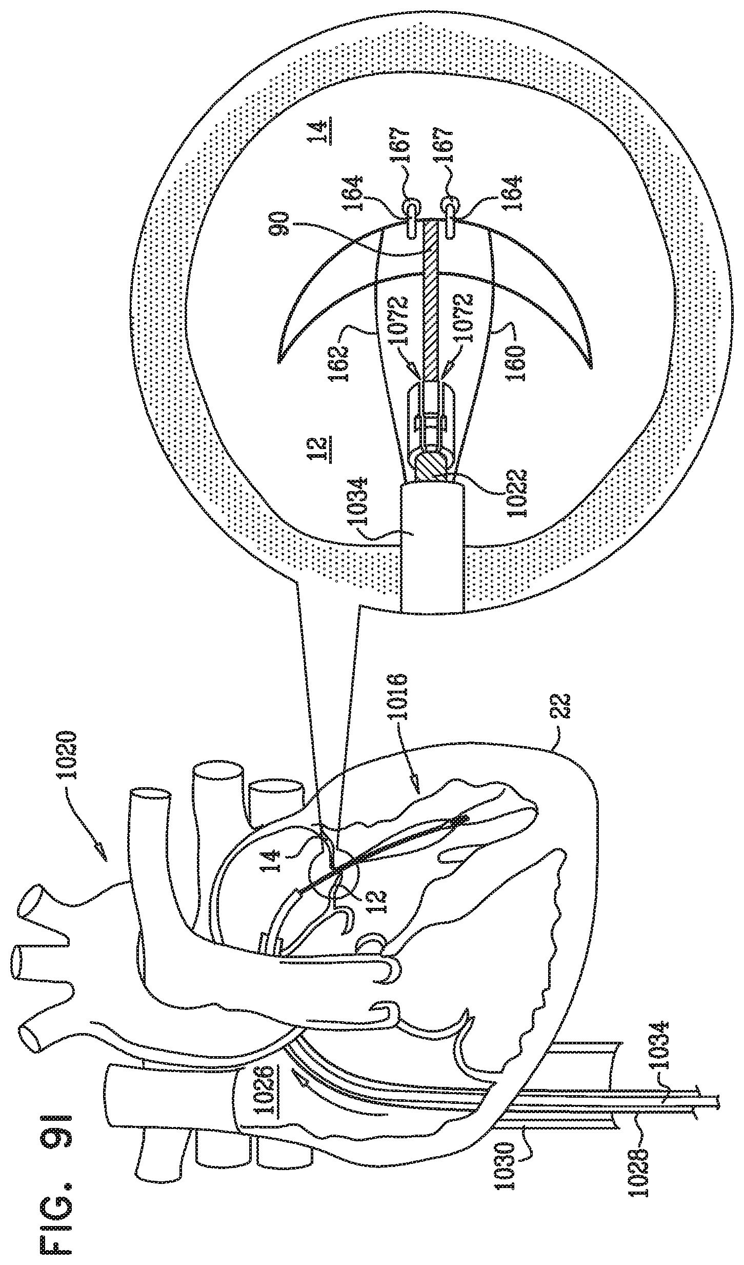 Patent US12350149 Figure 20 – Method and apparatus for repairing a heart valve