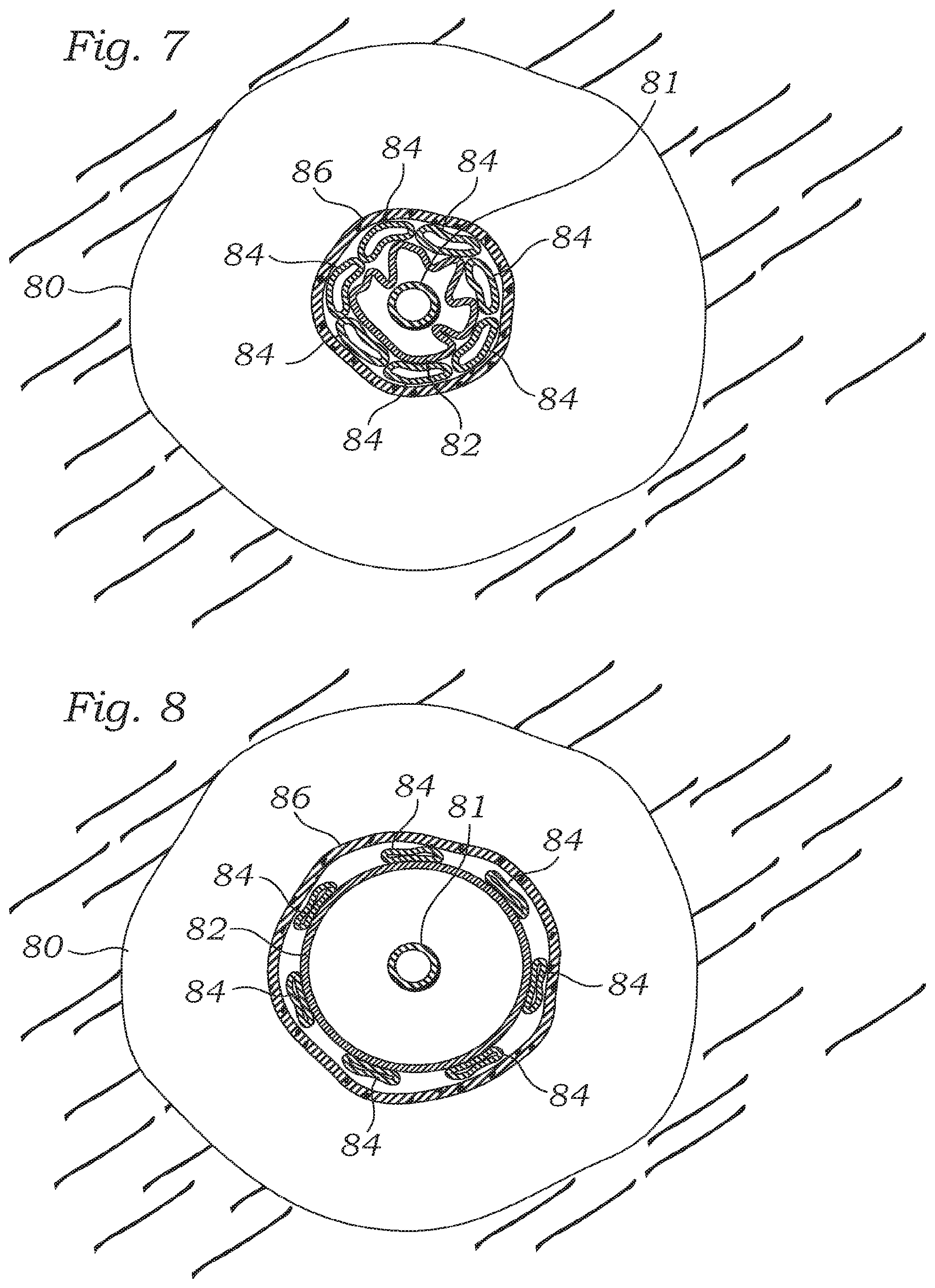 Patent US12350150 Figure 4 – Stability device for use with percutaneous delivery systems