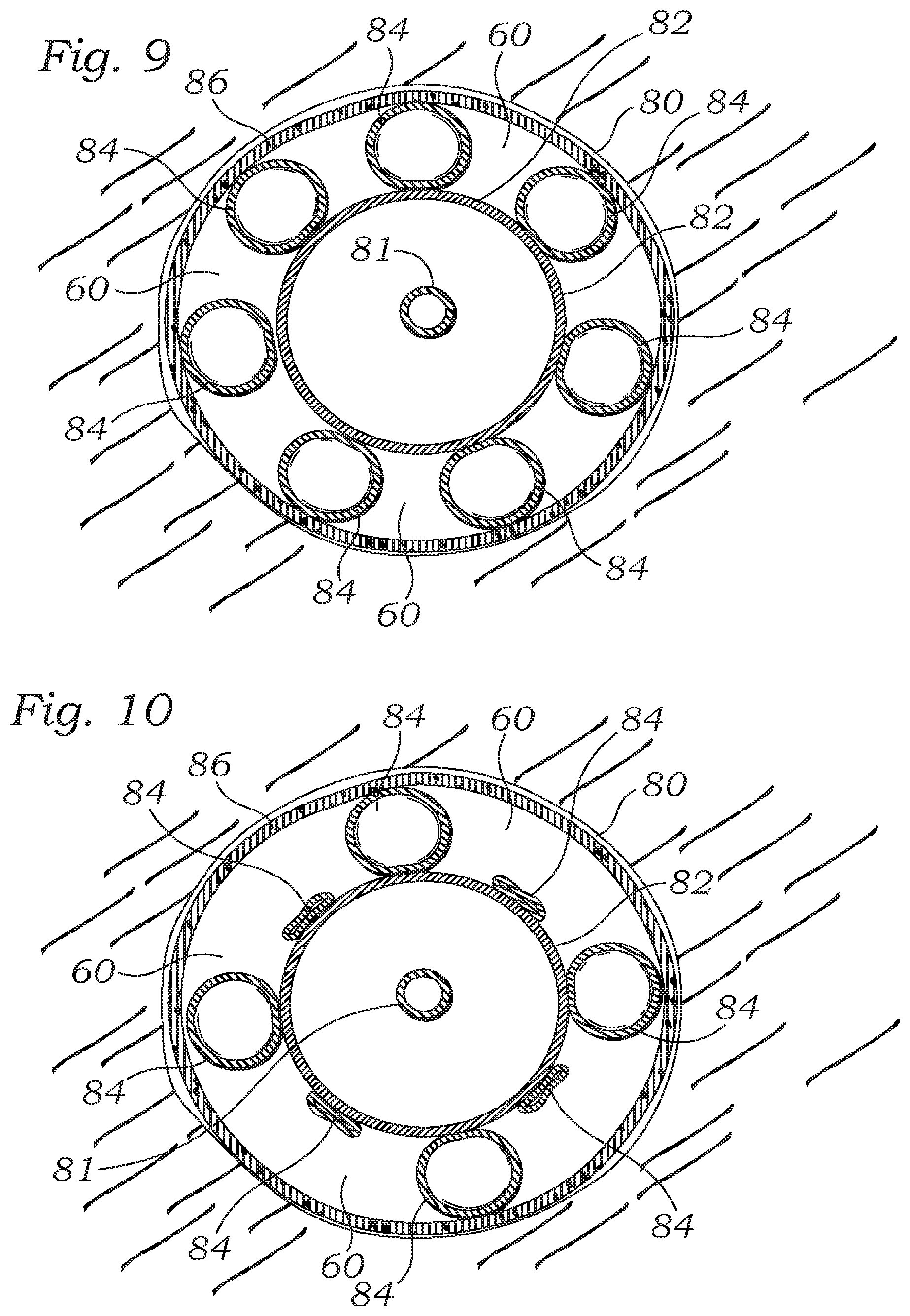Patent US12350150 Figure 5 – Stability device for use with percutaneous delivery systems