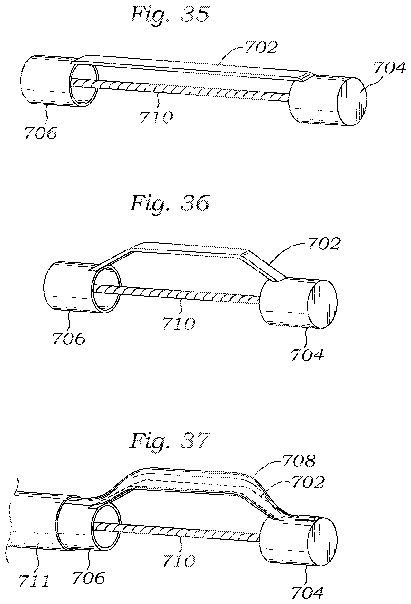 Patent US12350150 Figure 15 – Stability device for use with percutaneous delivery systems
