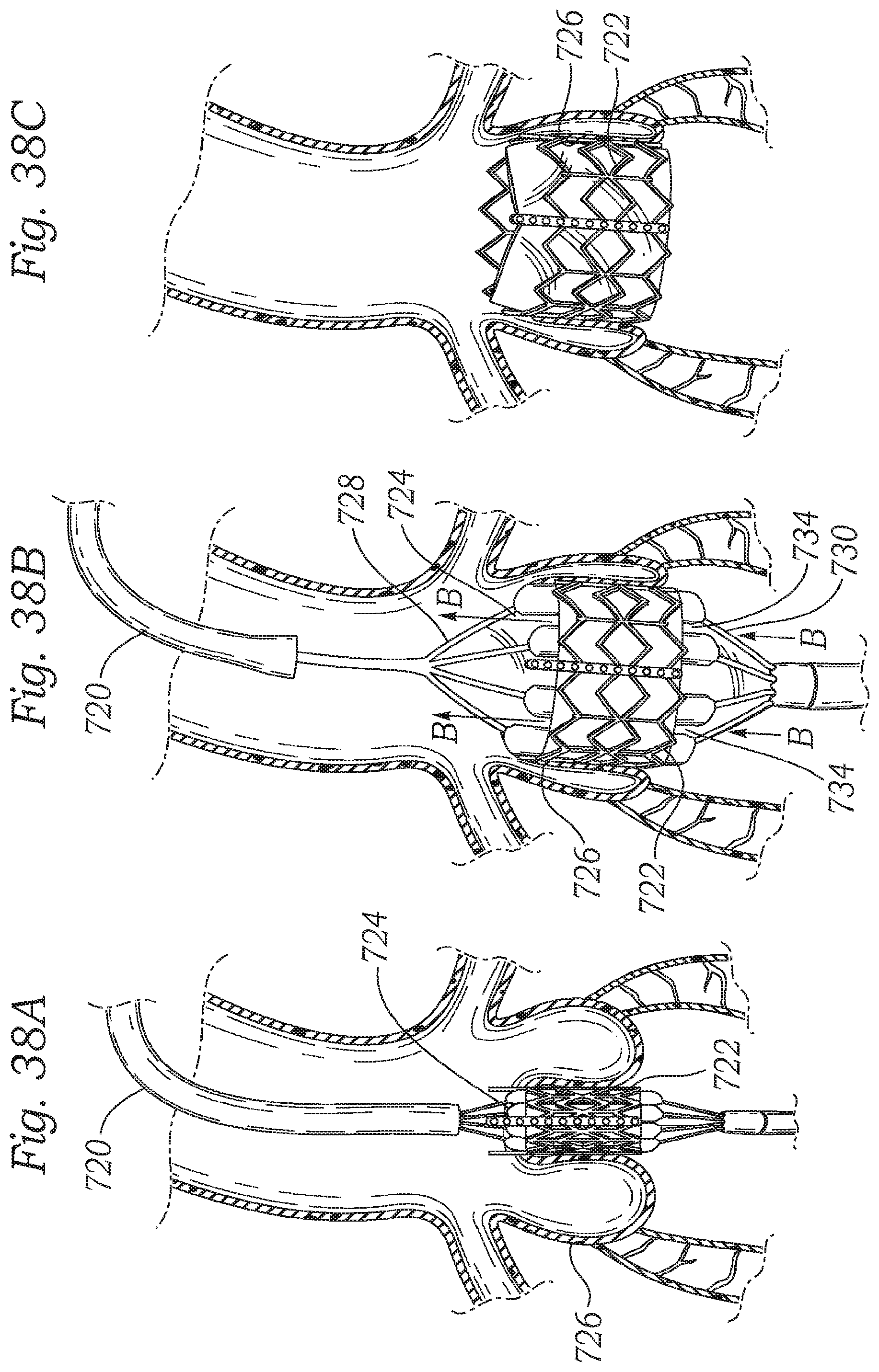 Patent US12350150 Figure 16 – Stability device for use with percutaneous delivery systems