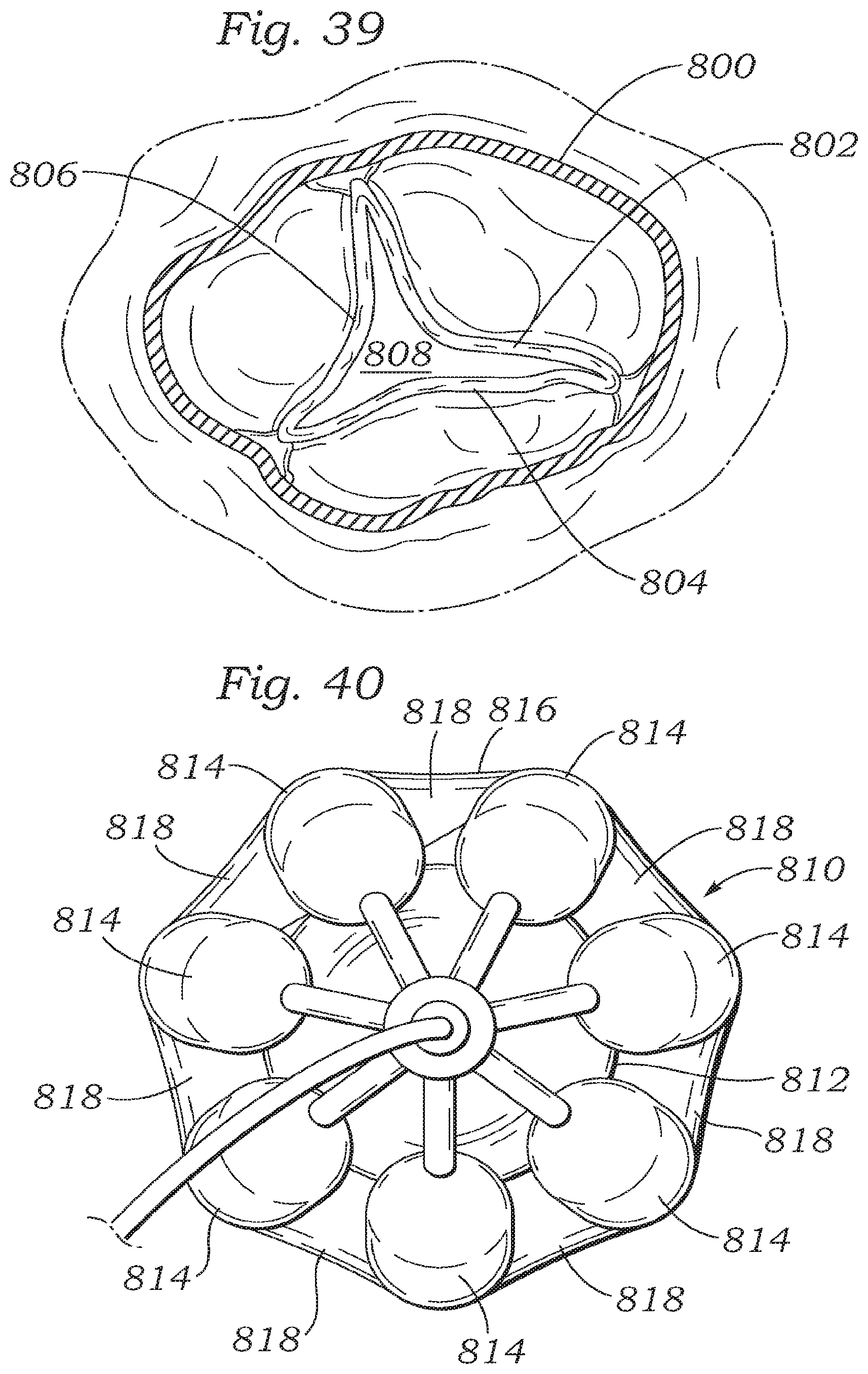 Patent US12350150 Figure 17 – Stability device for use with percutaneous delivery systems
