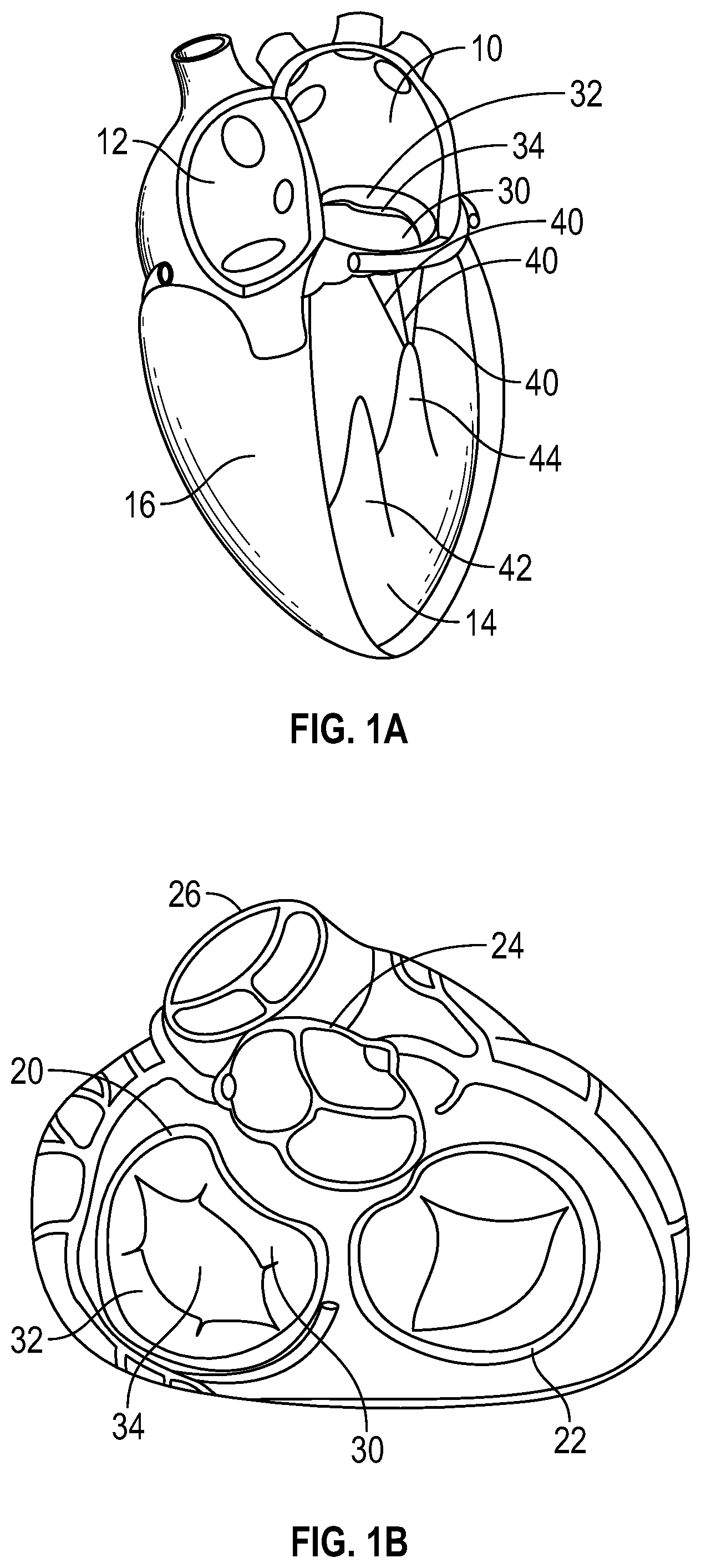 Patent US12350153 Figure 1 – Systems and methods for transcatheter treatment of valve regurgitation