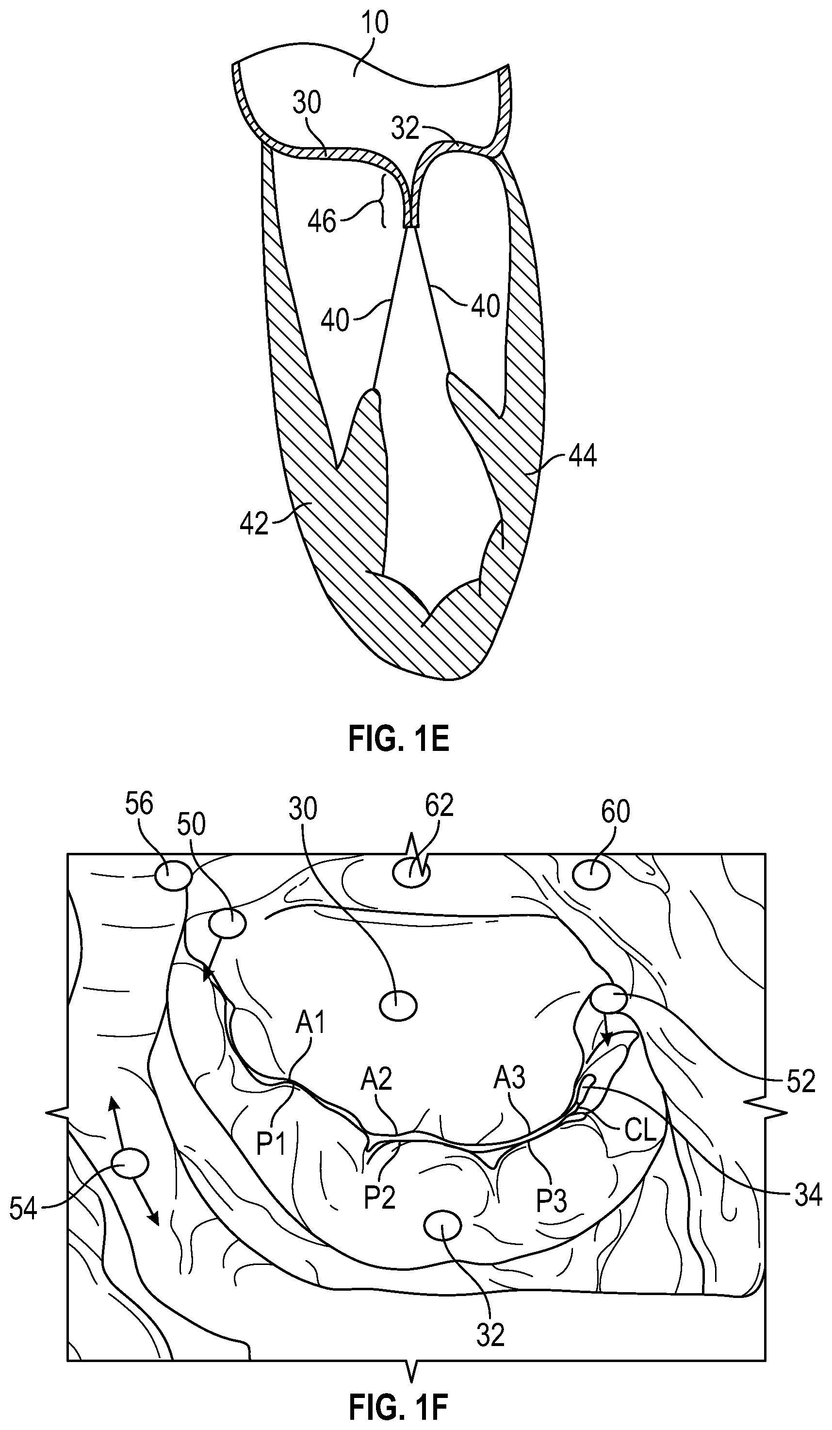 Patent US12350153 Figure 3 – Systems and methods for transcatheter treatment of valve regurgitation