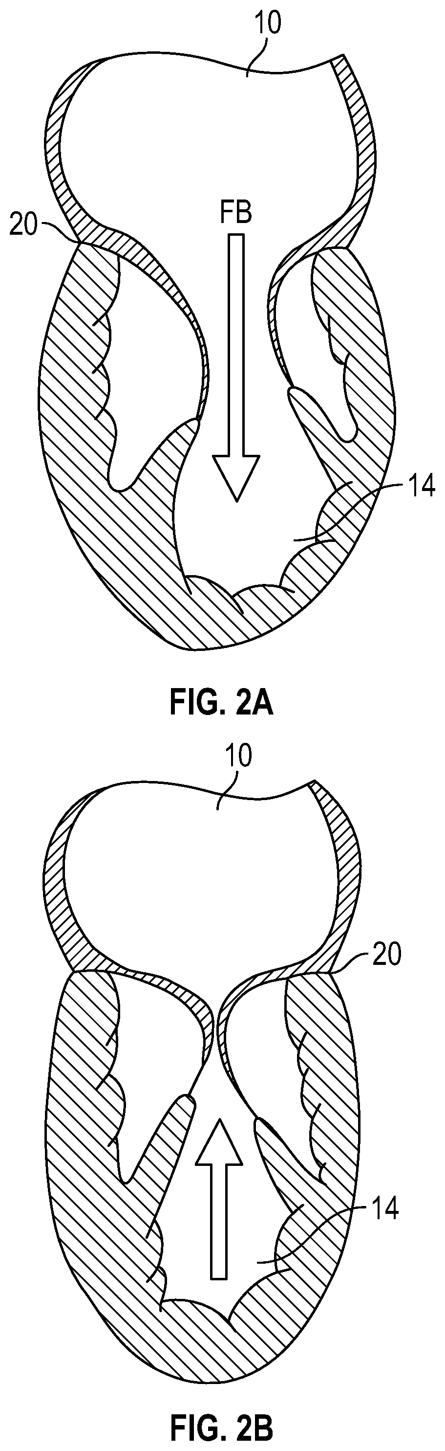 Patent US12350153 Figure 4 – Systems and methods for transcatheter treatment of valve regurgitation