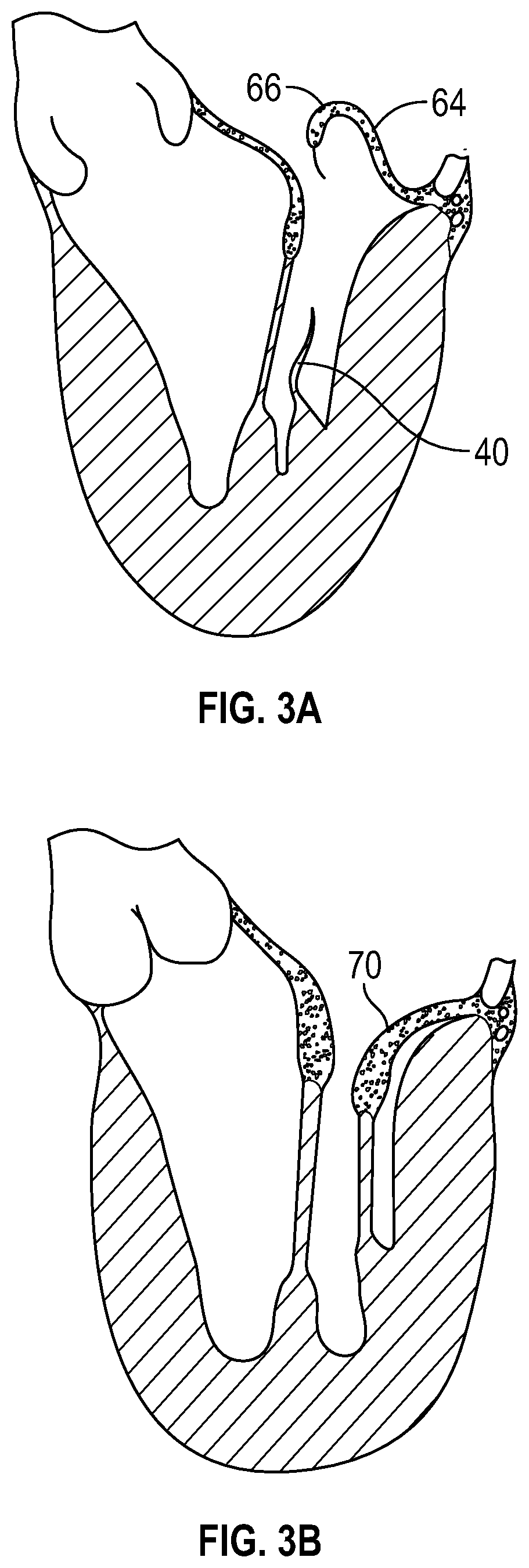 Patent US12350153 Figure 5 – Systems and methods for transcatheter treatment of valve regurgitation
