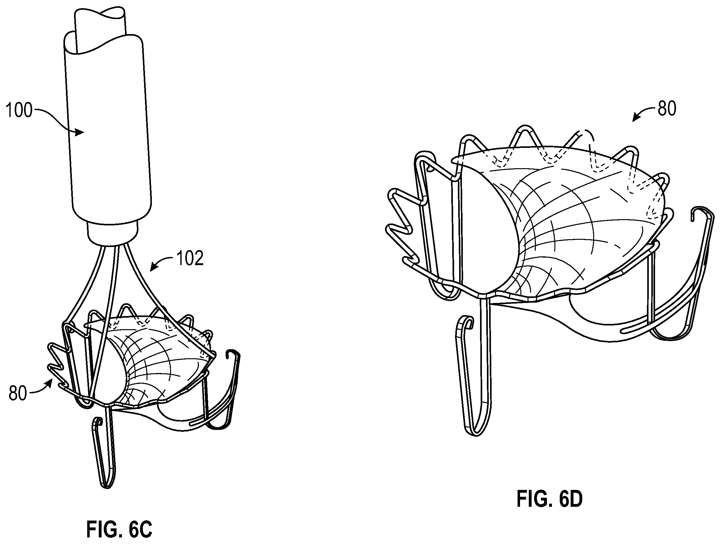 Patent US12350153 Figure 10 – Systems and methods for transcatheter treatment of valve regurgitation