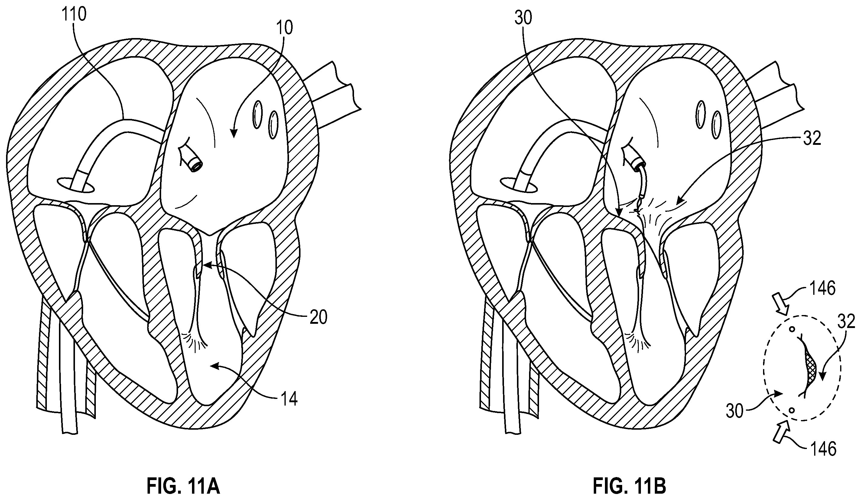 Patent US12350153 Figure 15 – Systems and methods for transcatheter treatment of valve regurgitation
