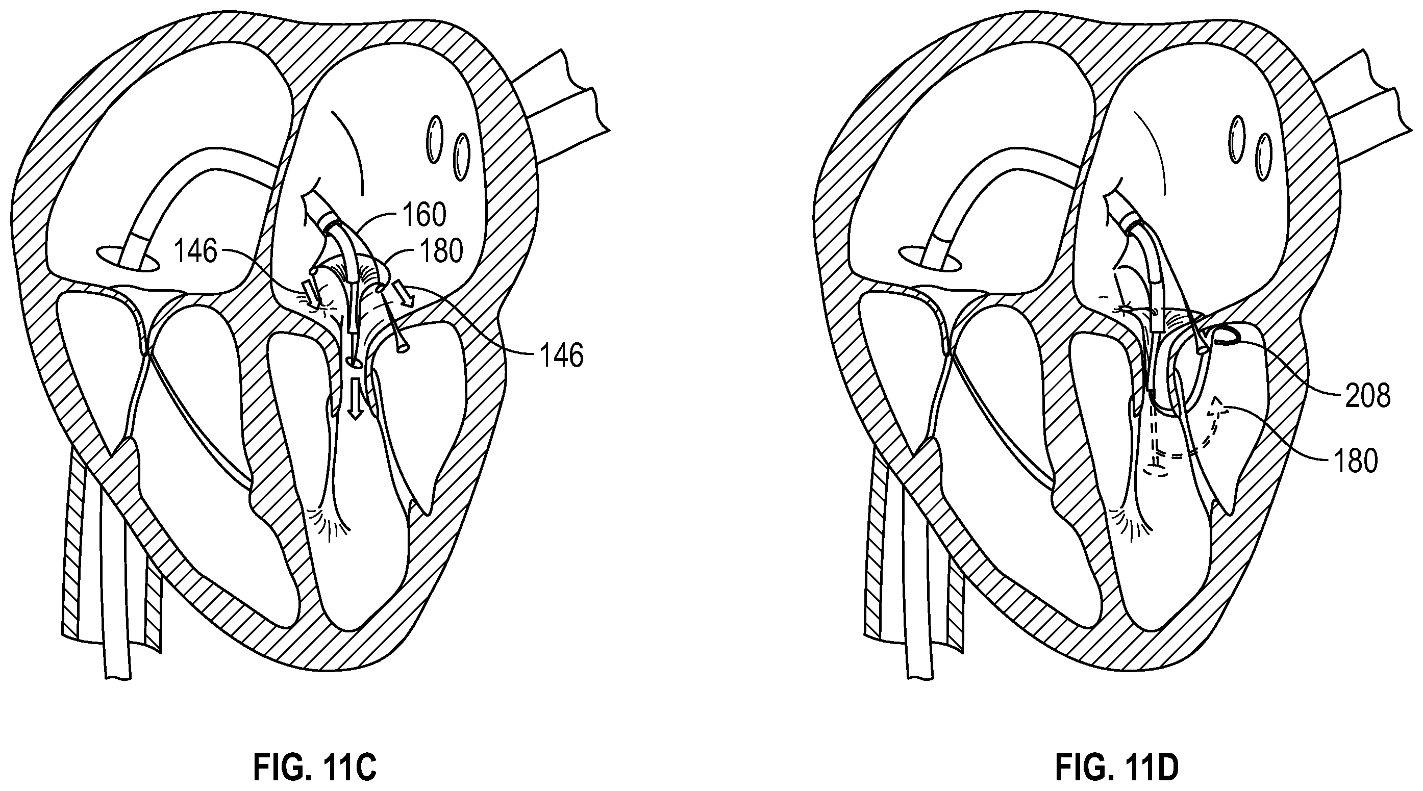 Patent US12350153 Figure 16 – Systems and methods for transcatheter treatment of valve regurgitation