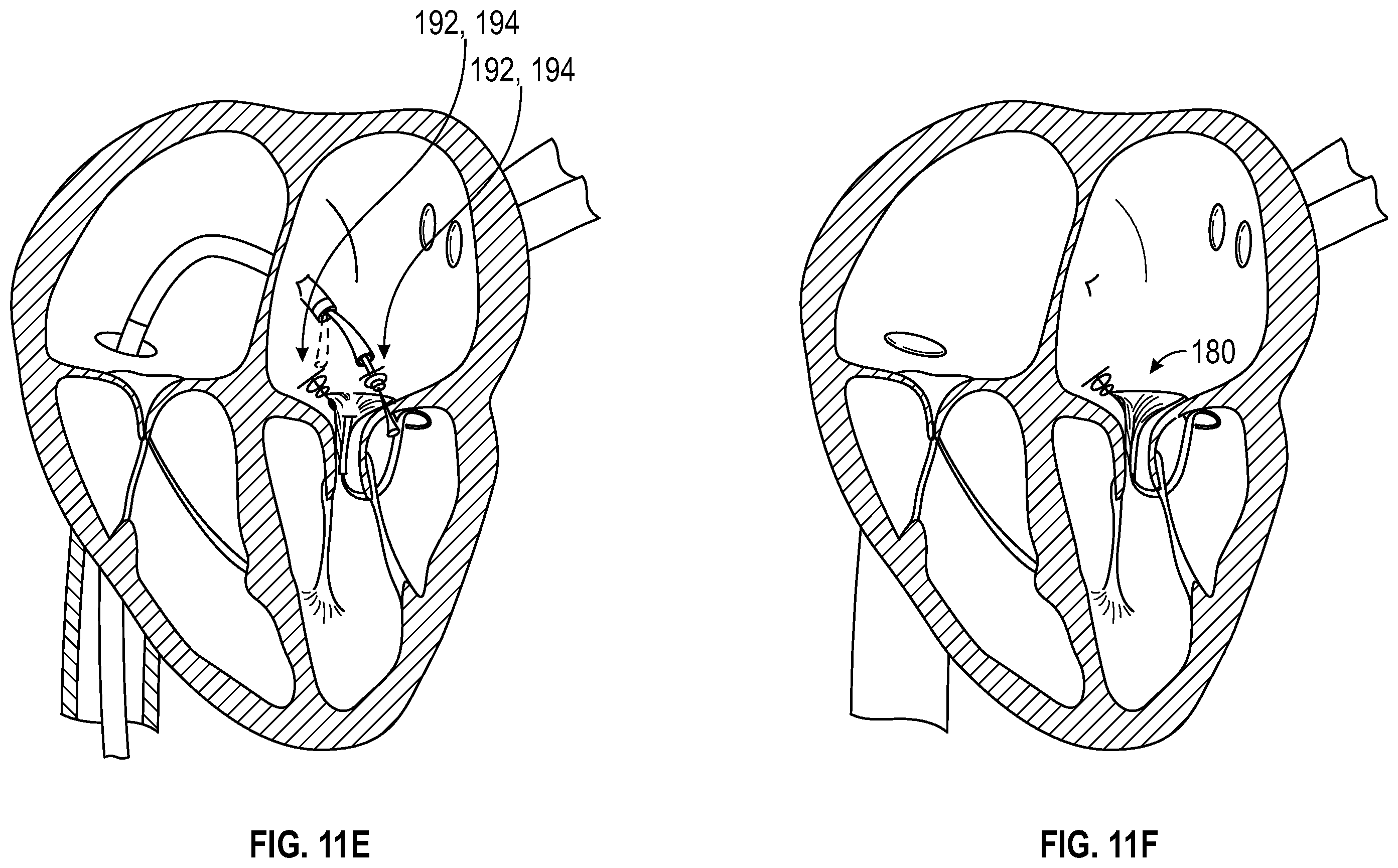 Patent US12350153 Figure 17 – Systems and methods for transcatheter treatment of valve regurgitation