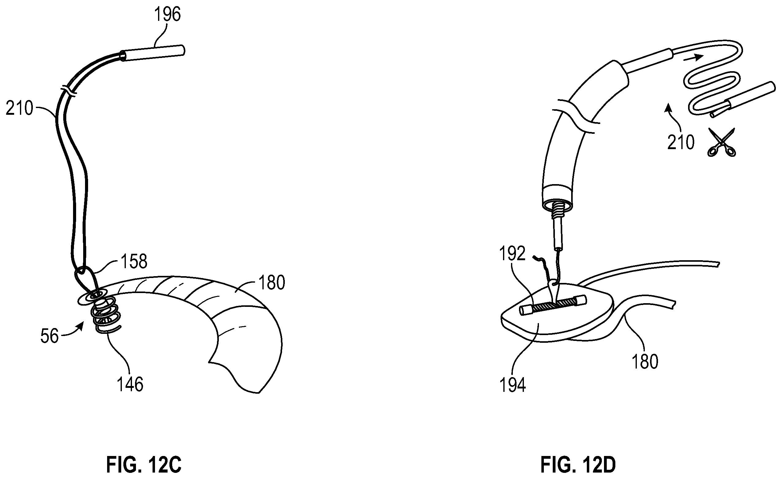 Patent US12350153 Figure 19 – Systems and methods for transcatheter treatment of valve regurgitation