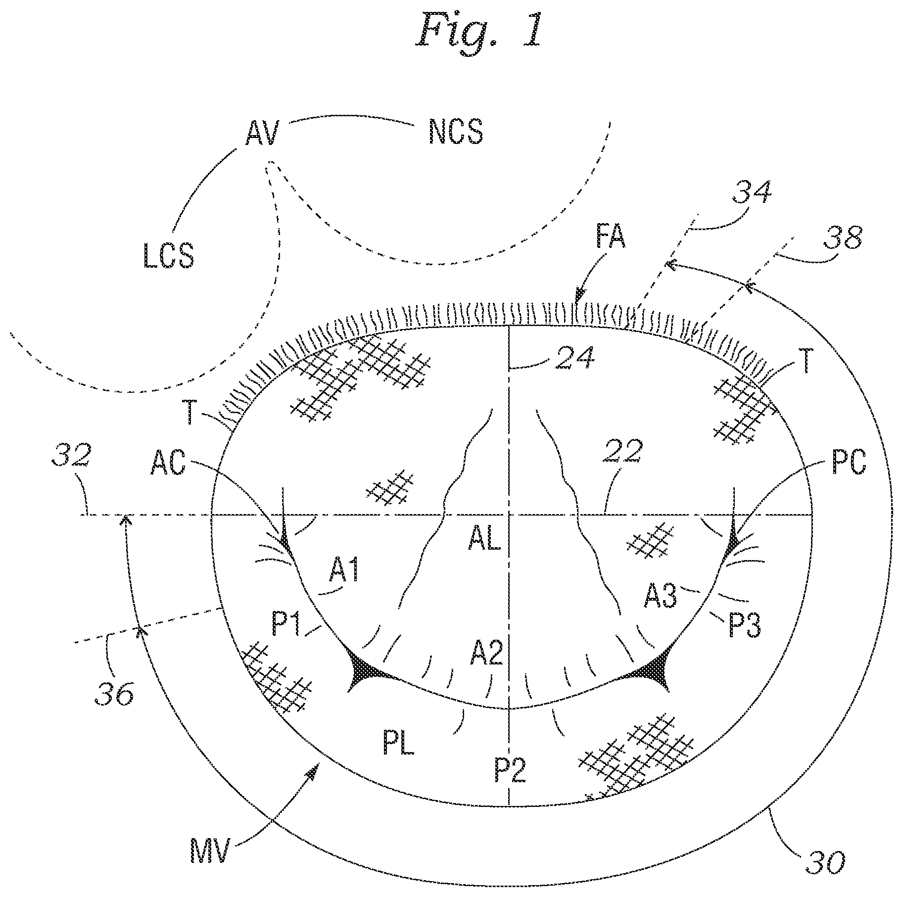 Patent US12350154 Figure 1 – Method for implanting an asymmetric mitral annuloplasty band