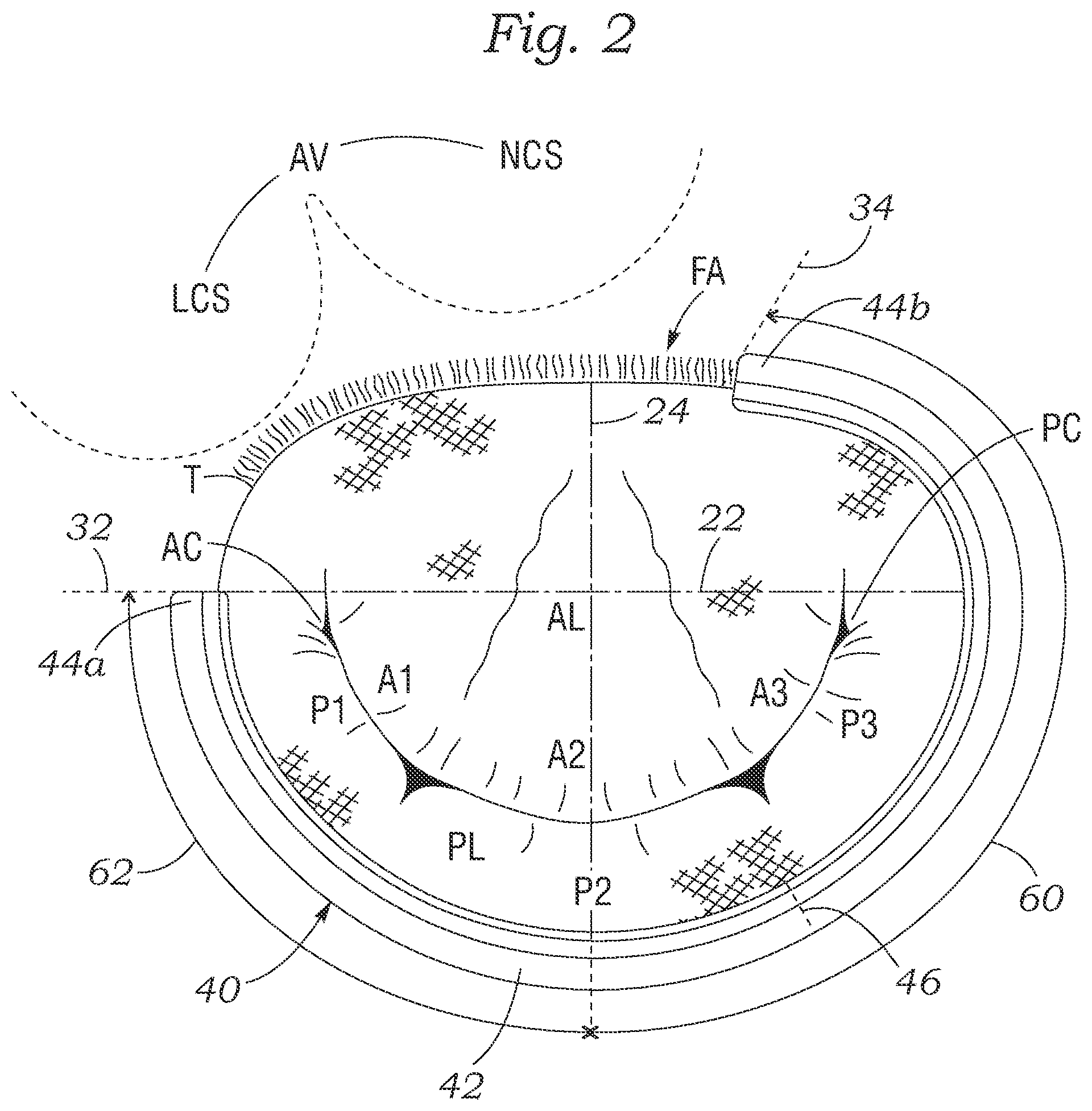Patent US12350154 Figure 2 – Method for implanting an asymmetric mitral annuloplasty band