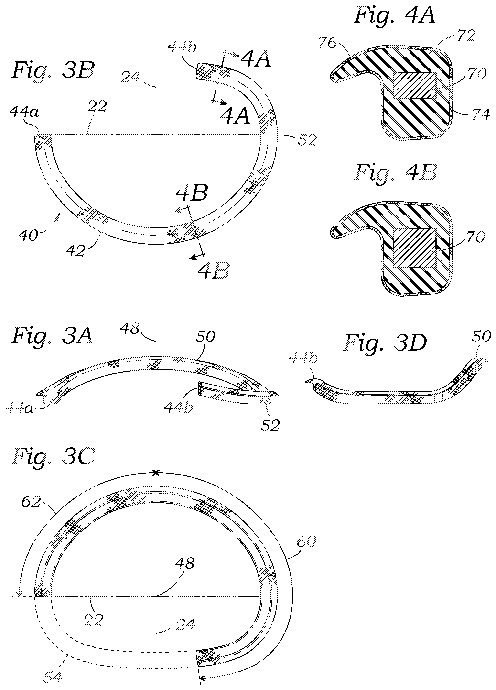 Patent US12350154 Figure 3 – Method for implanting an asymmetric mitral annuloplasty band