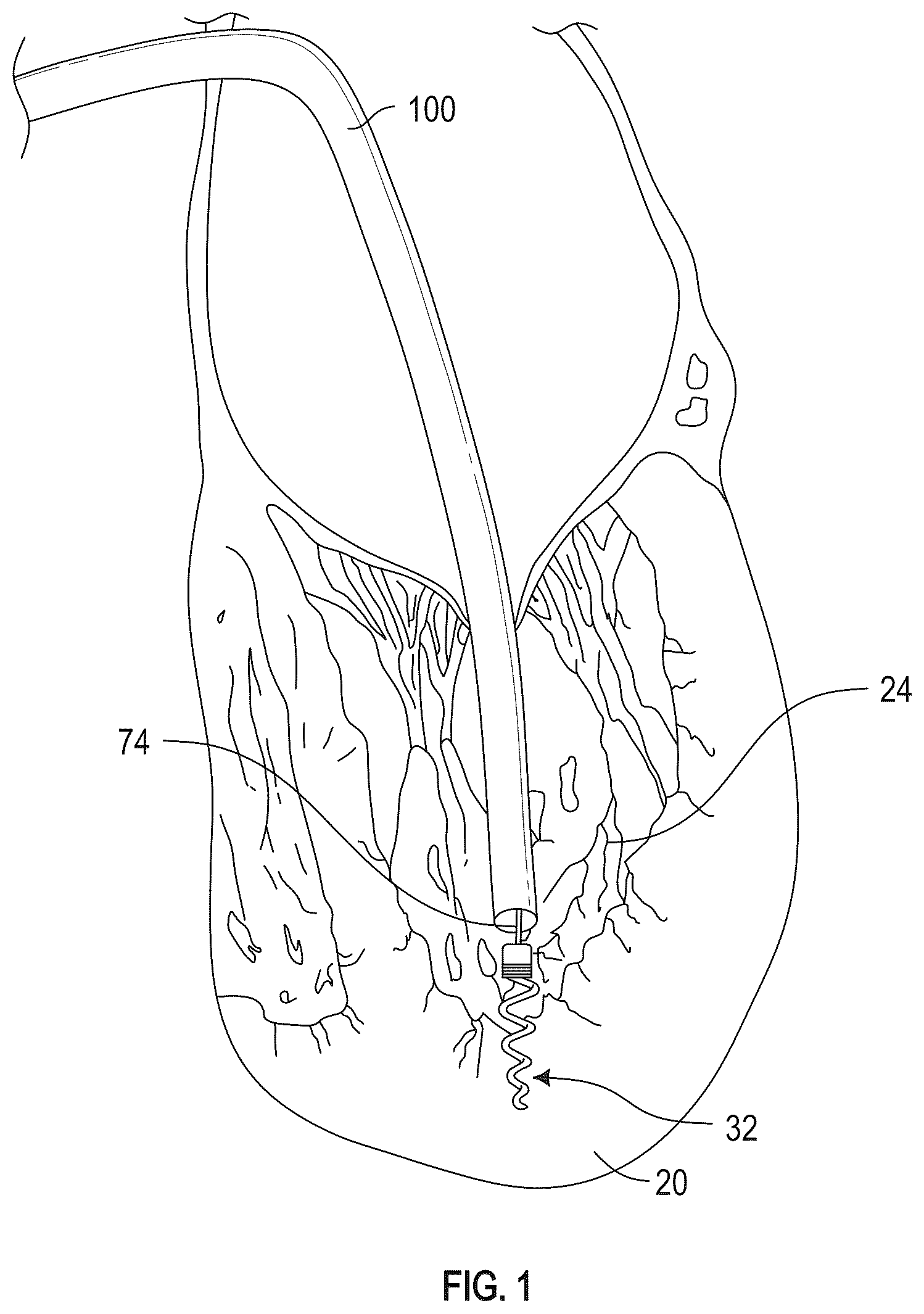 Patent US12350155 Figure 1 – Method and apparatus for mitral valve chord repair