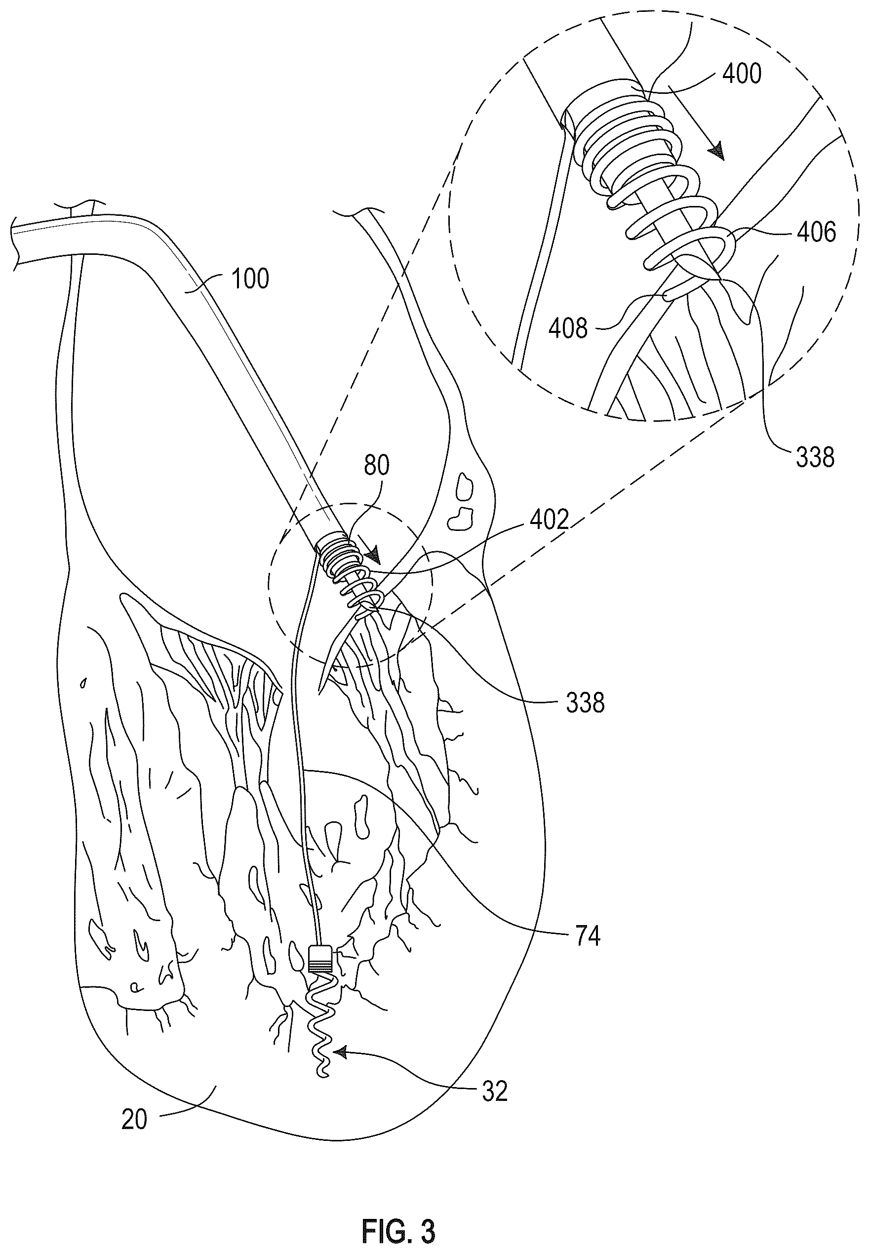 Patent US12350155 Figure 6 – Method and apparatus for mitral valve chord repair
