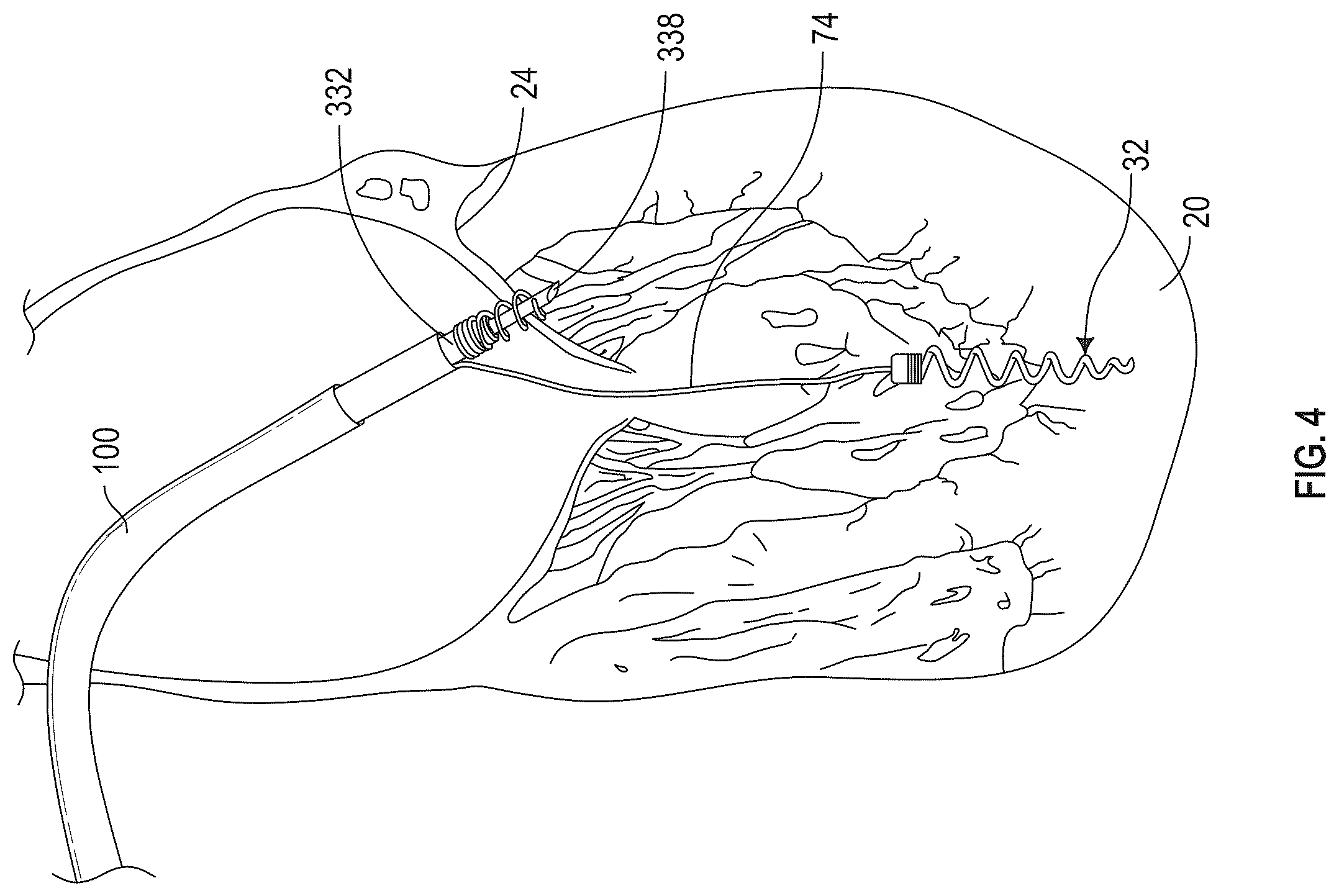 Patent US12350155 Figure 7 – Method and apparatus for mitral valve chord repair