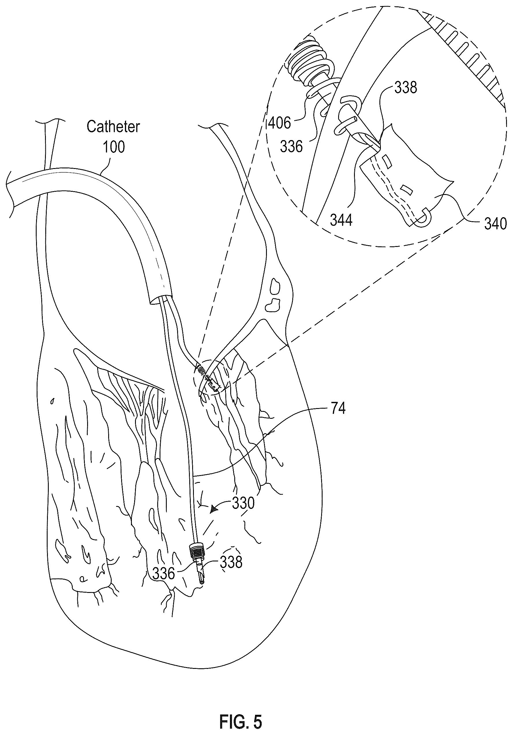 Patent US12350155 Figure 8 – Method and apparatus for mitral valve chord repair