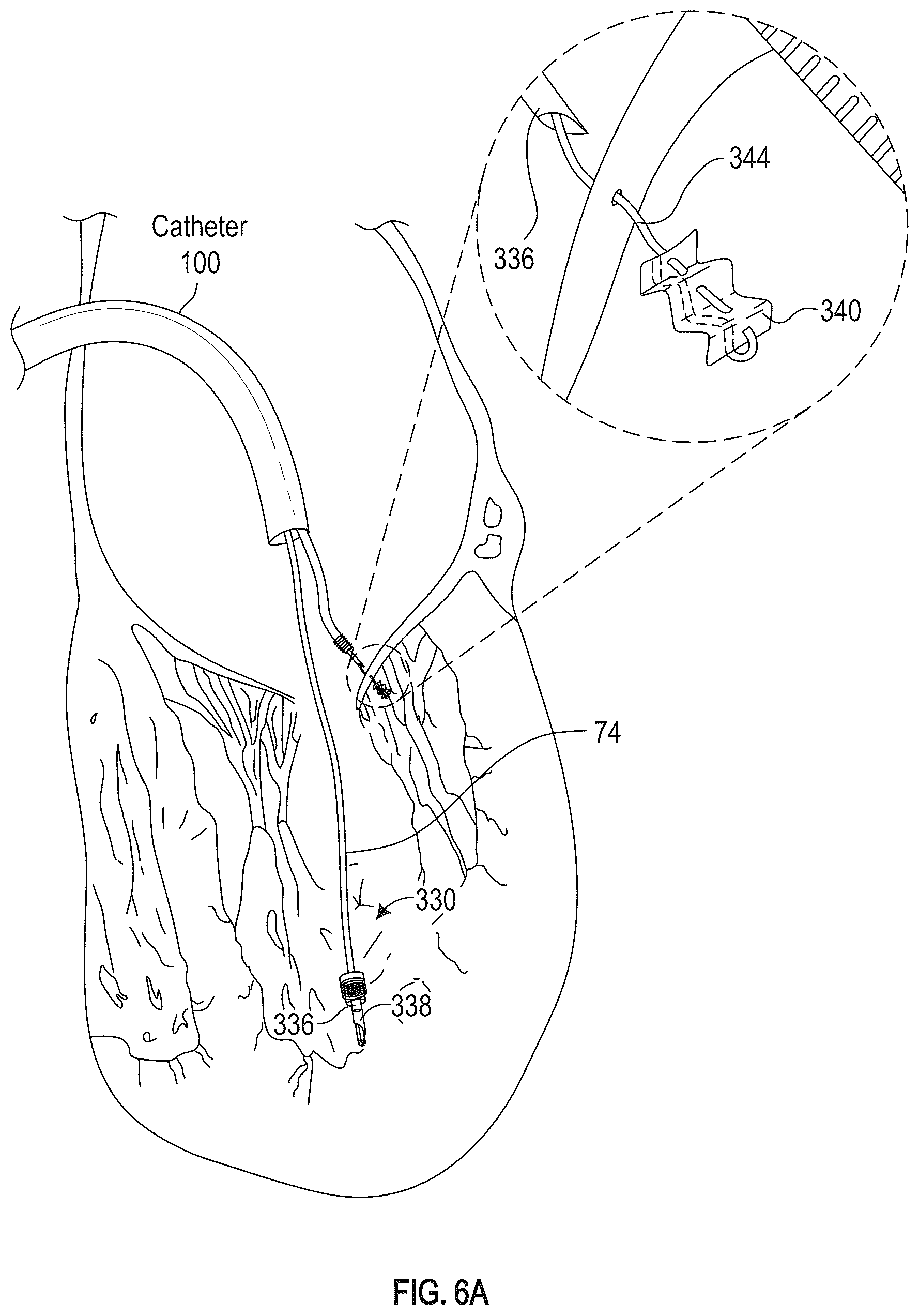 Patent US12350155 Figure 9 – Method and apparatus for mitral valve chord repair
