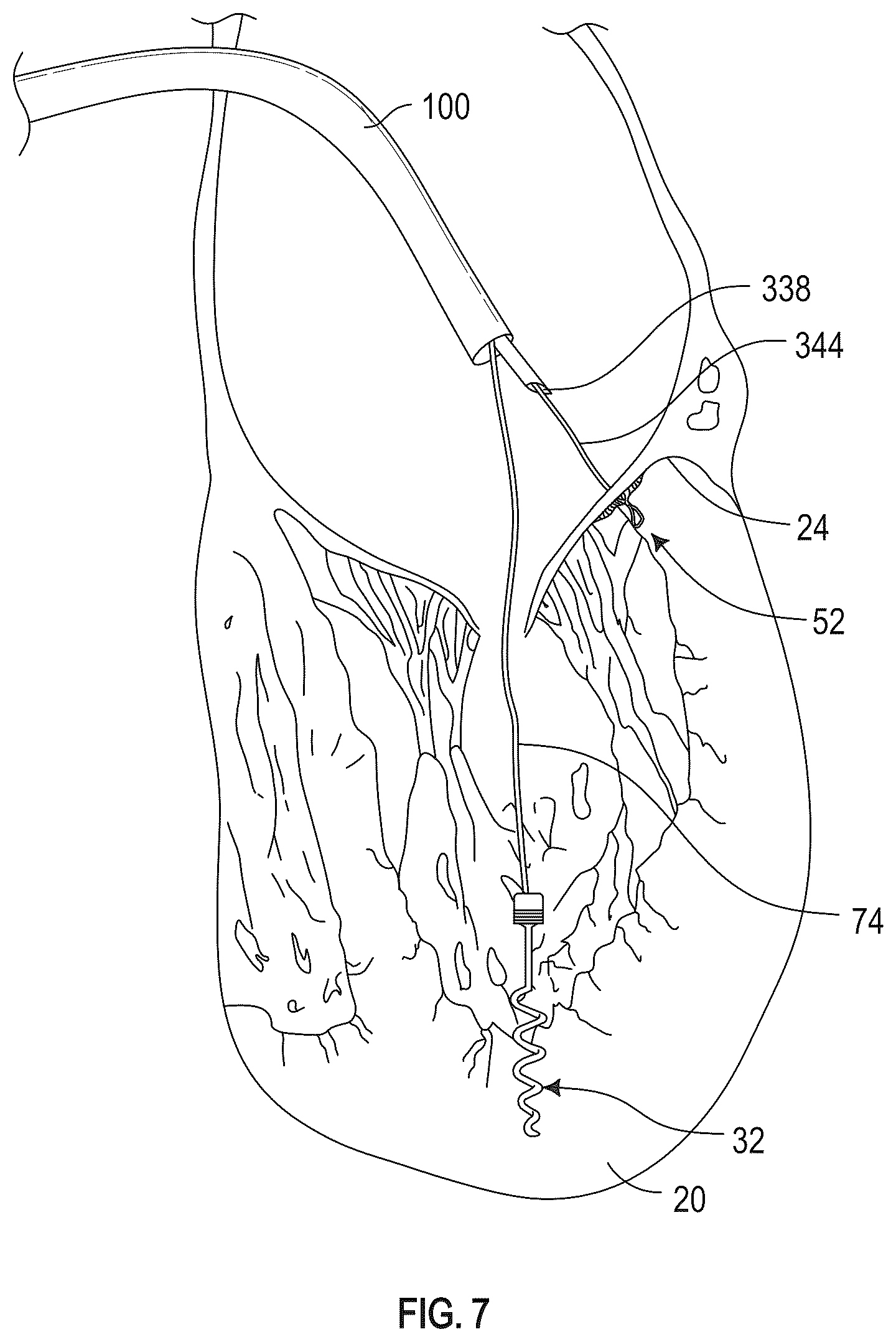 Patent US12350155 Figure 11 – Method and apparatus for mitral valve chord repair