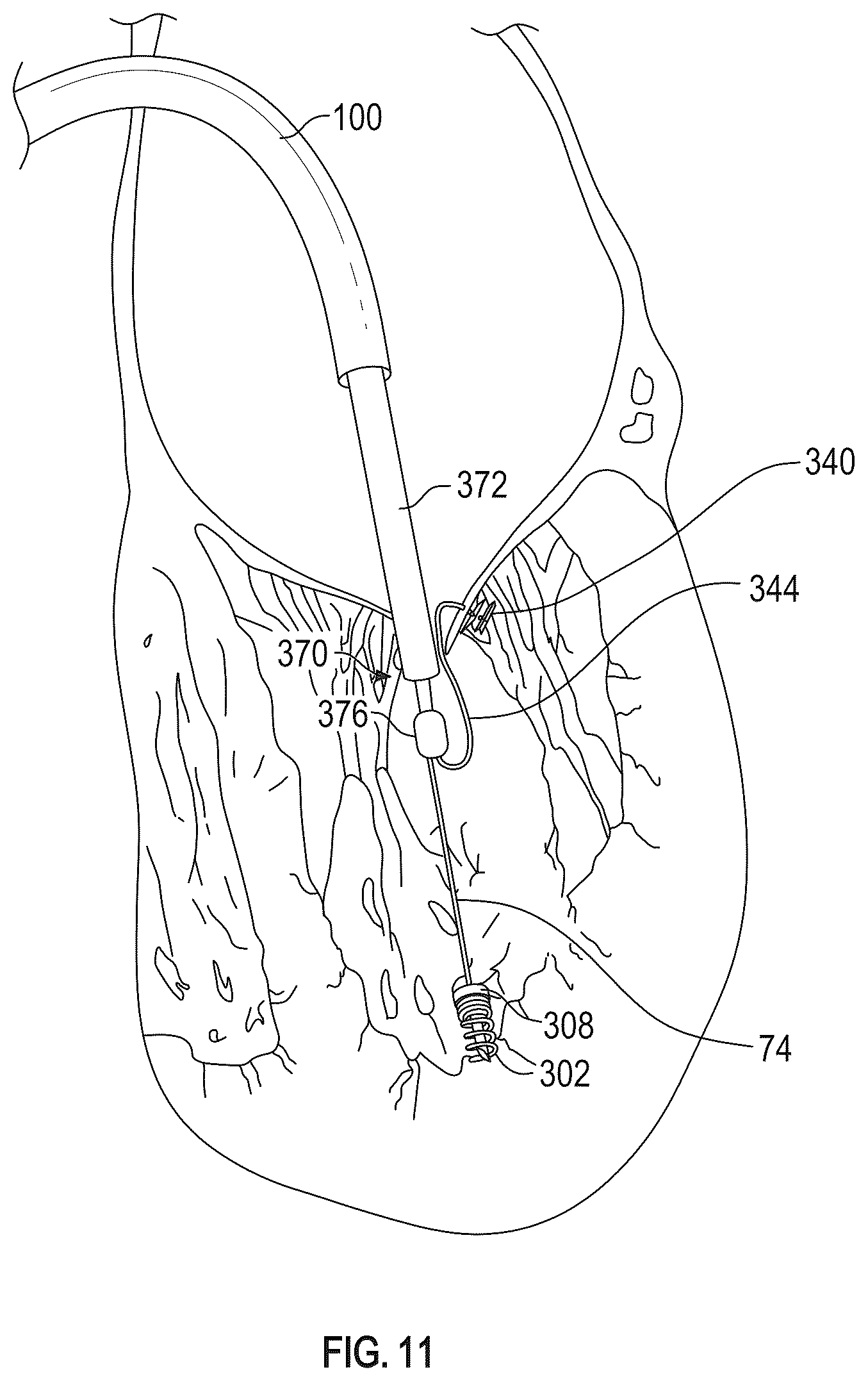Patent US12350155 Figure 14 – Method and apparatus for mitral valve chord repair