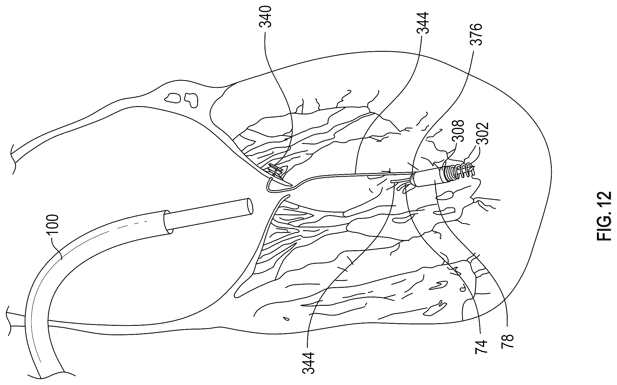 Patent US12350155 Figure 15 – Method and apparatus for mitral valve chord repair