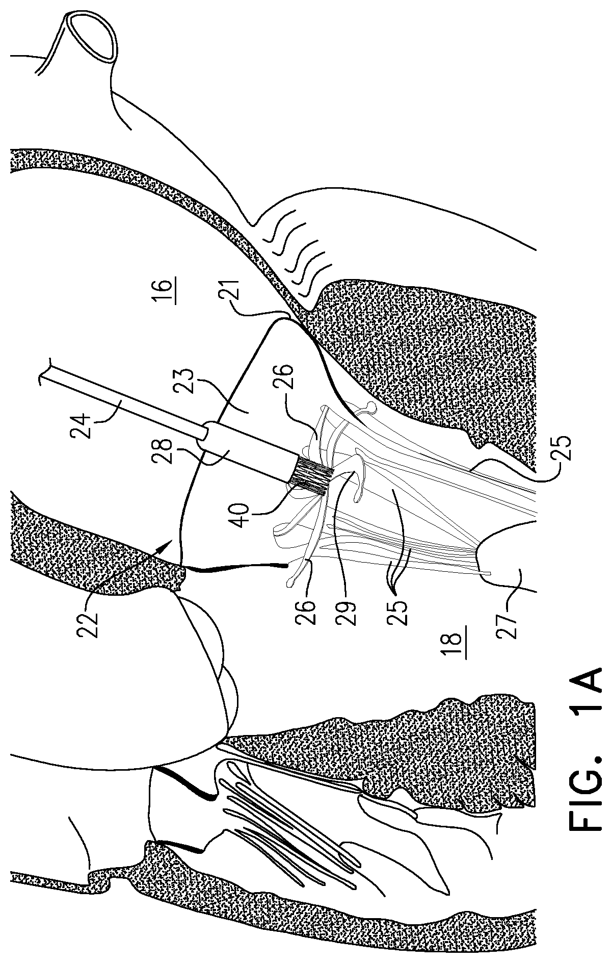 Patent US12350156 Figure 1 – Atrioventricular valve repair