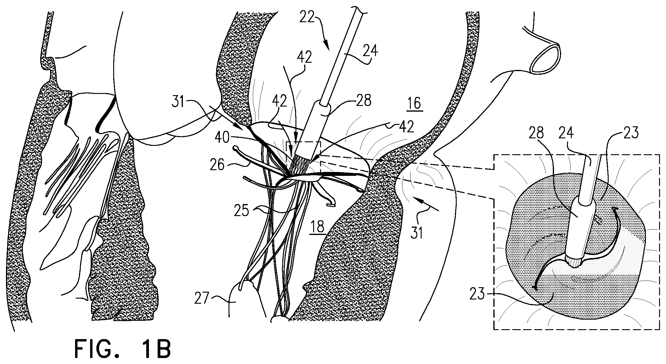 Patent US12350156 Figure 2 – Atrioventricular valve repair