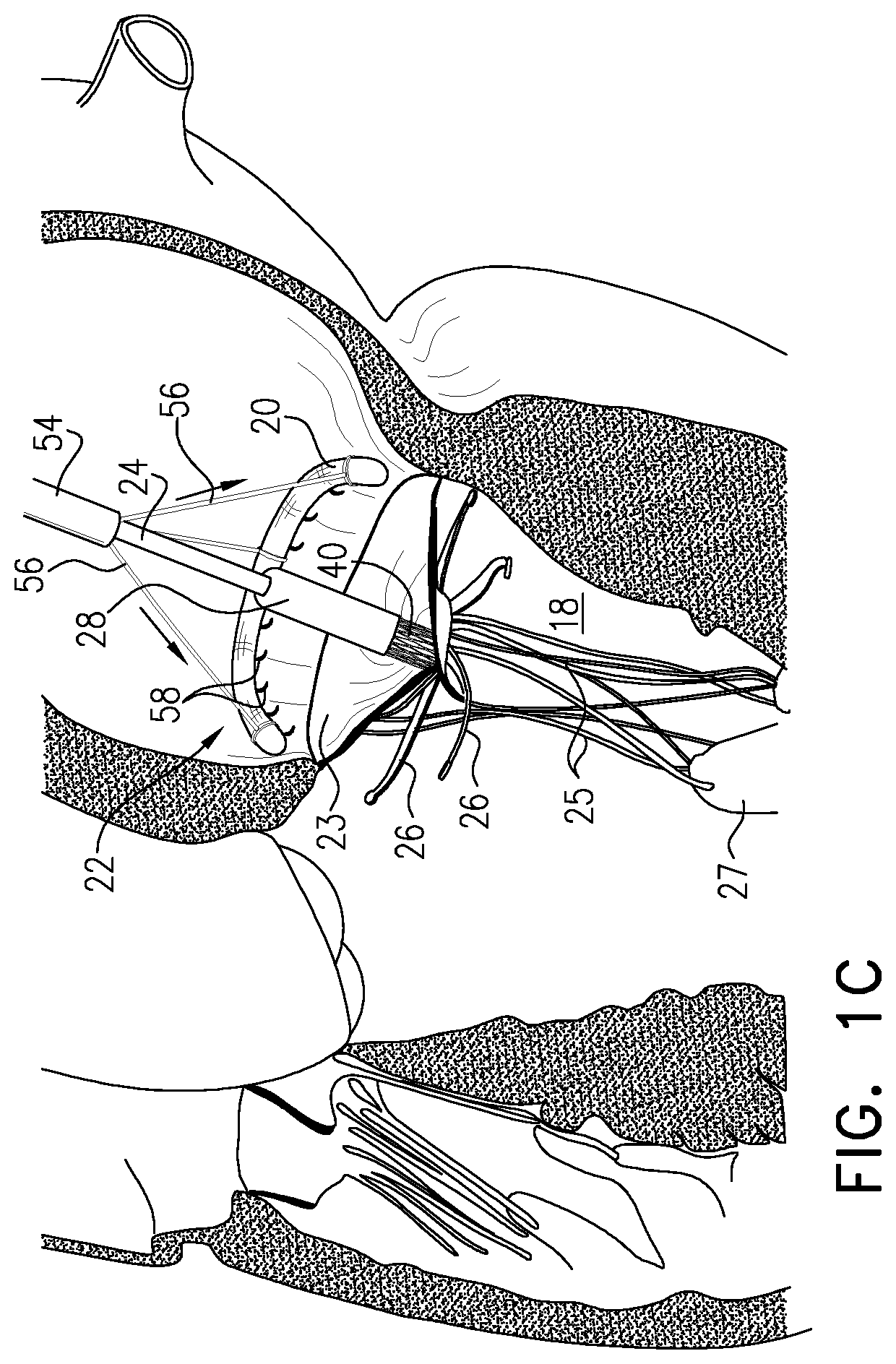 Patent US12350156 Figure 3 – Atrioventricular valve repair