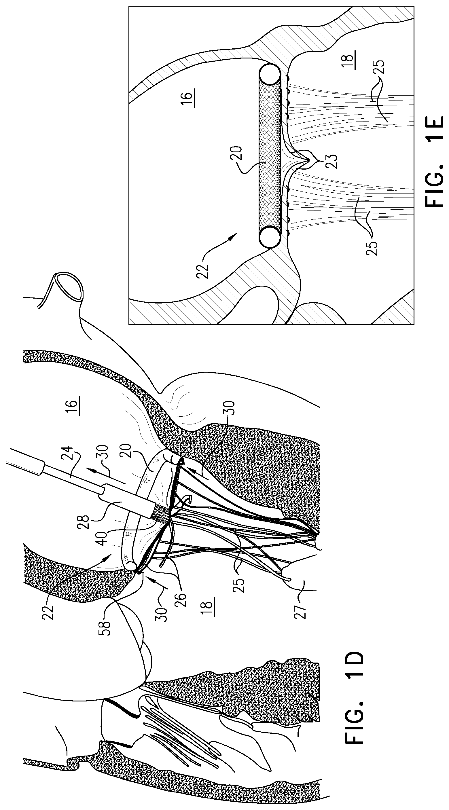 Patent US12350156 Figure 4 – Atrioventricular valve repair