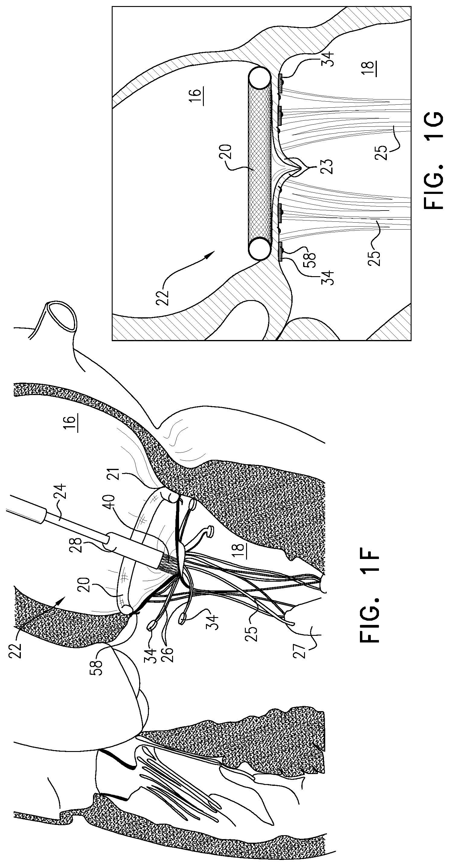 Patent US12350156 Figure 5 – Atrioventricular valve repair