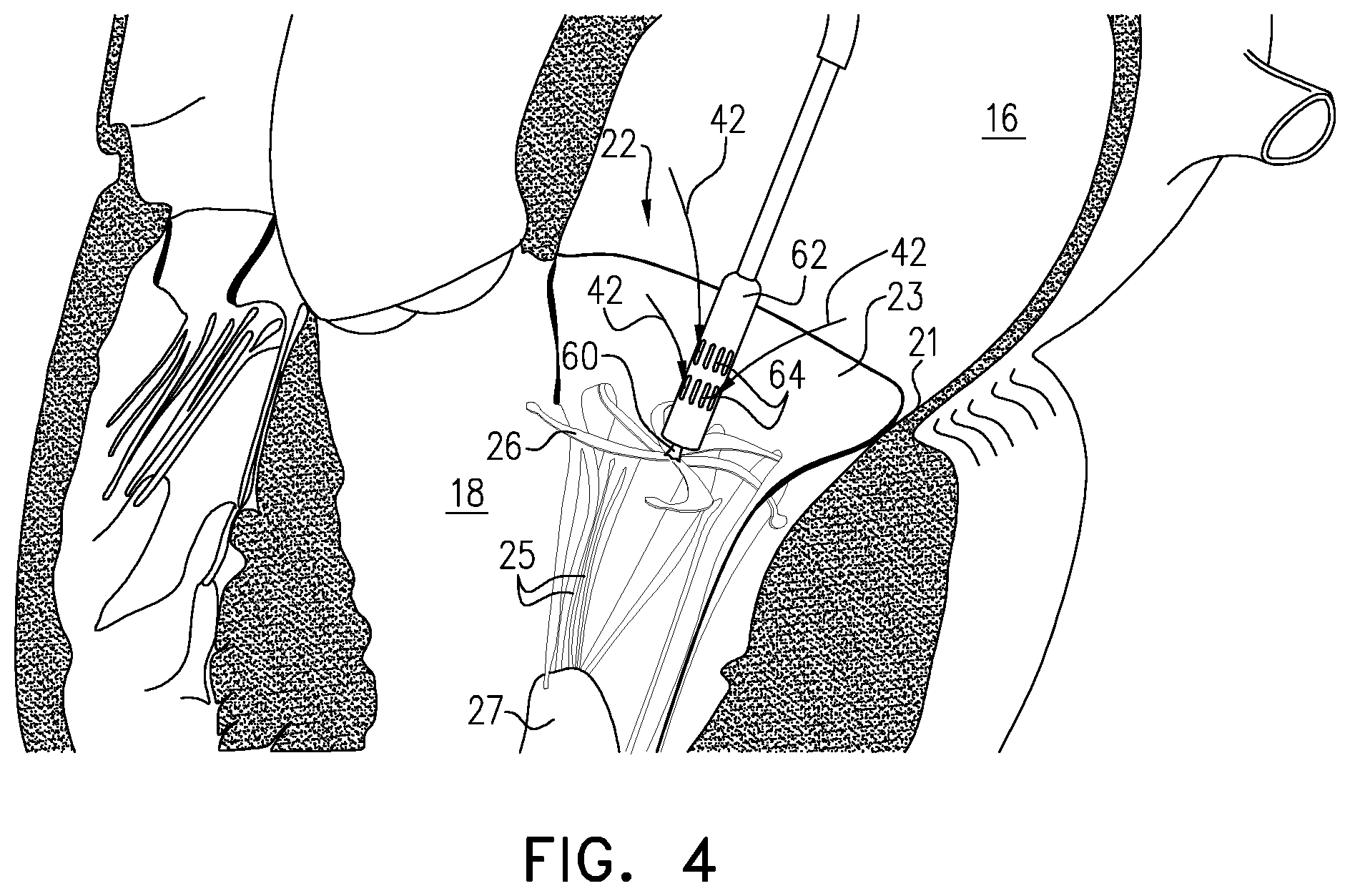 Patent US12350156 Figure 8 – Atrioventricular valve repair