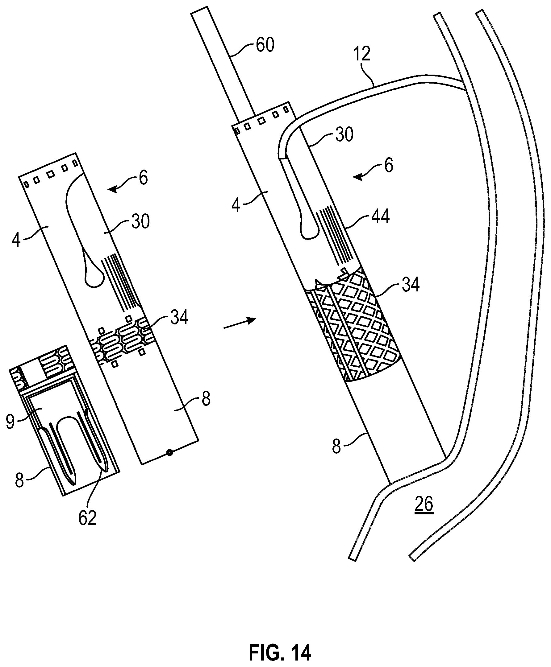 Patent US12350157 Figure 8 – Device for heart repair