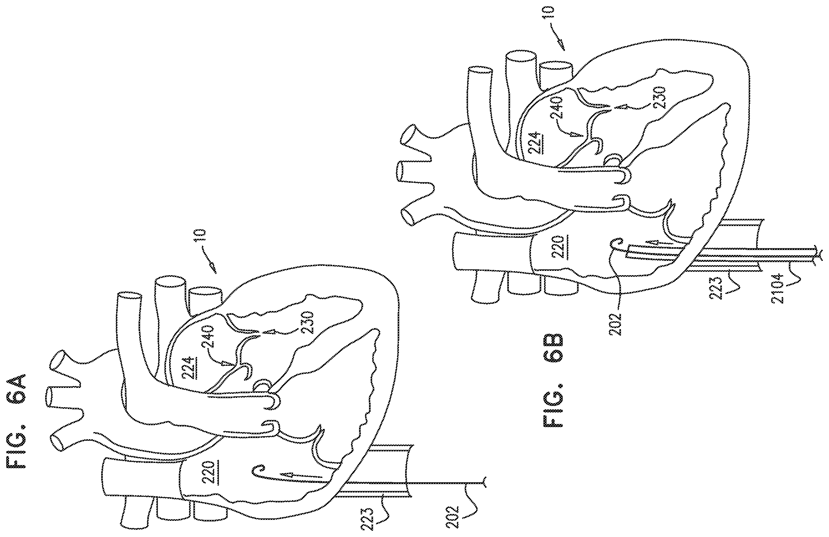 Patent US12350158 Figure 6 – Annuloplasty ring delivery catheters