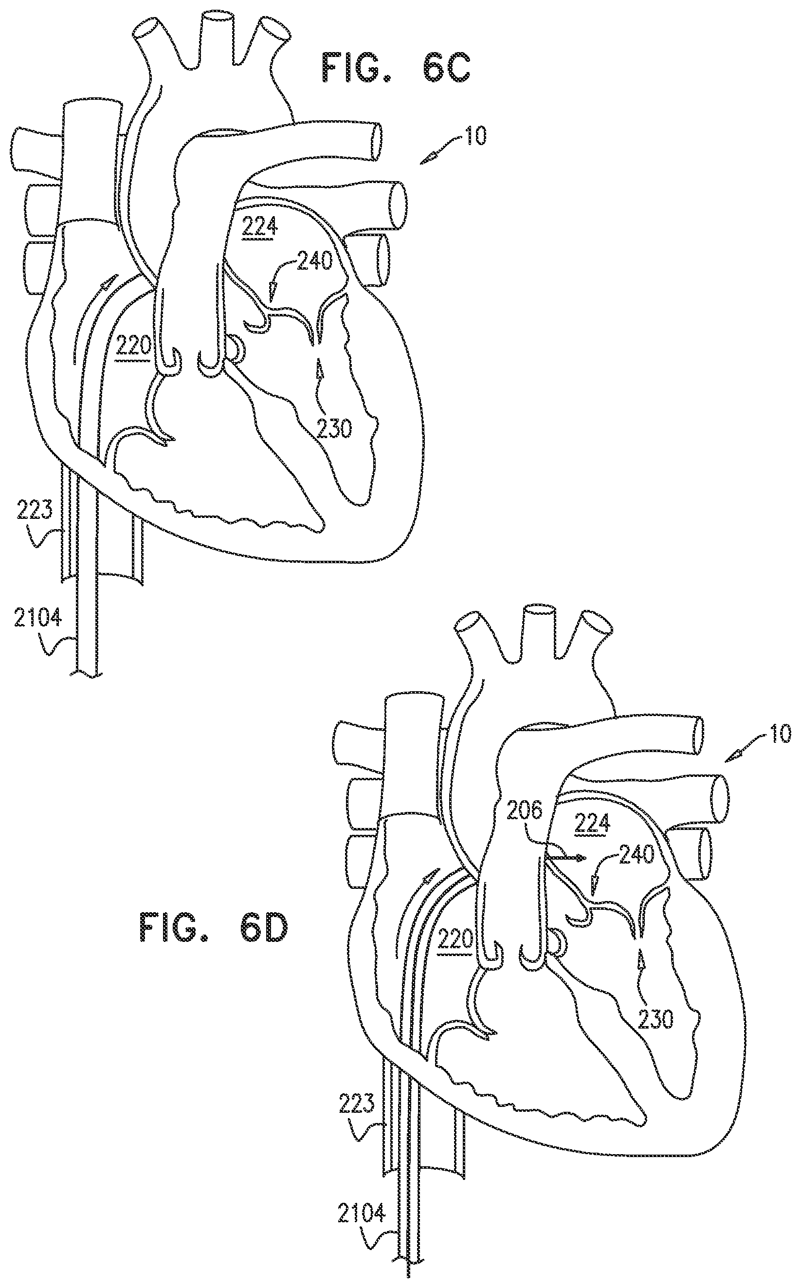 Patent US12350158 Figure 7 – Annuloplasty ring delivery catheters